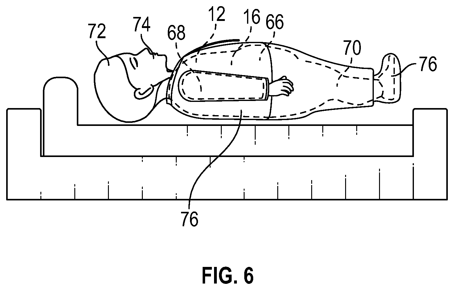 Patent US12102572 Figure 5 – Mortuary undergarment assembly