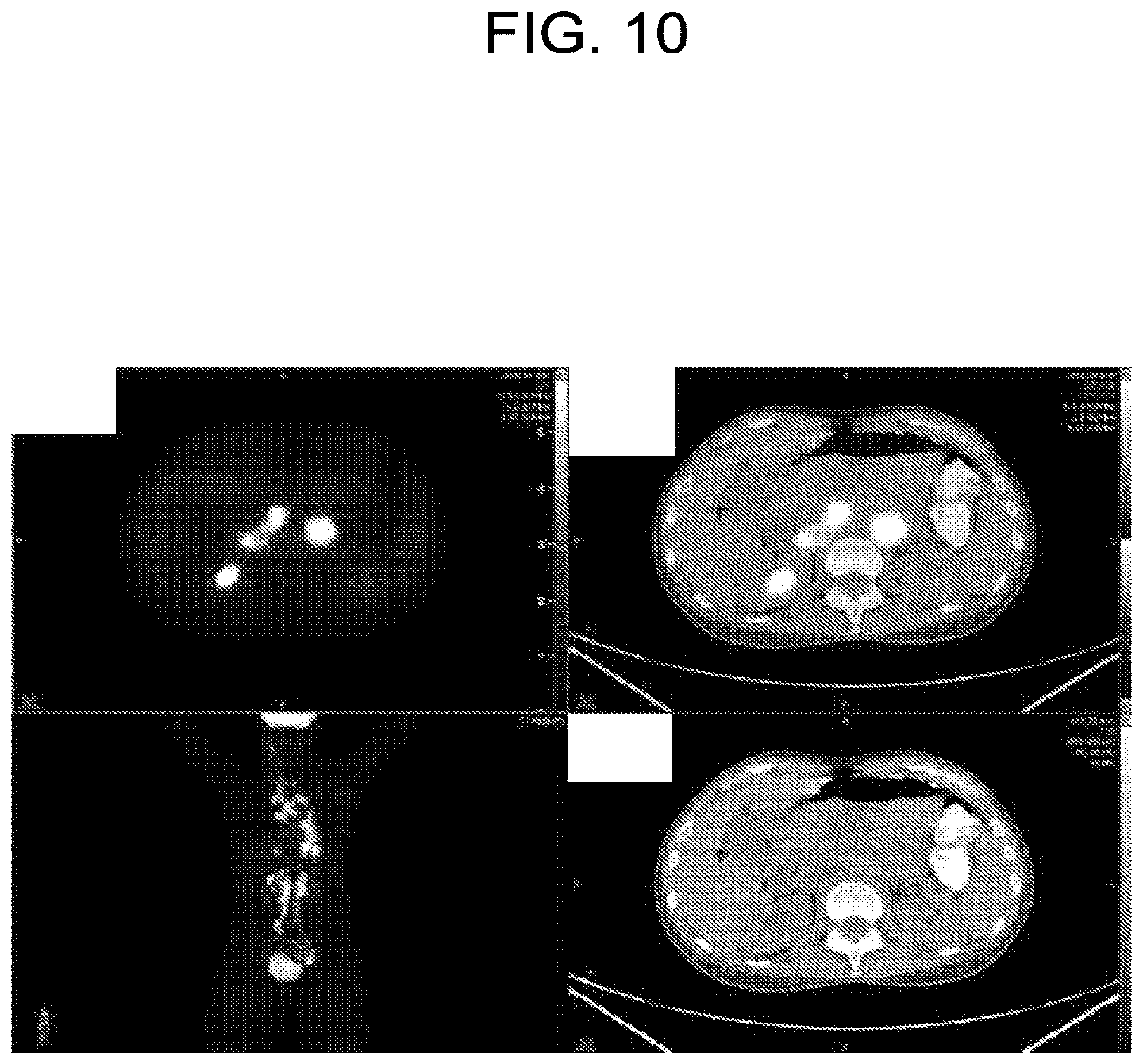 Patent US12102613 Figure 11 – Compositions, methods, systems and/or kits for preventing and/or treating neoplasms