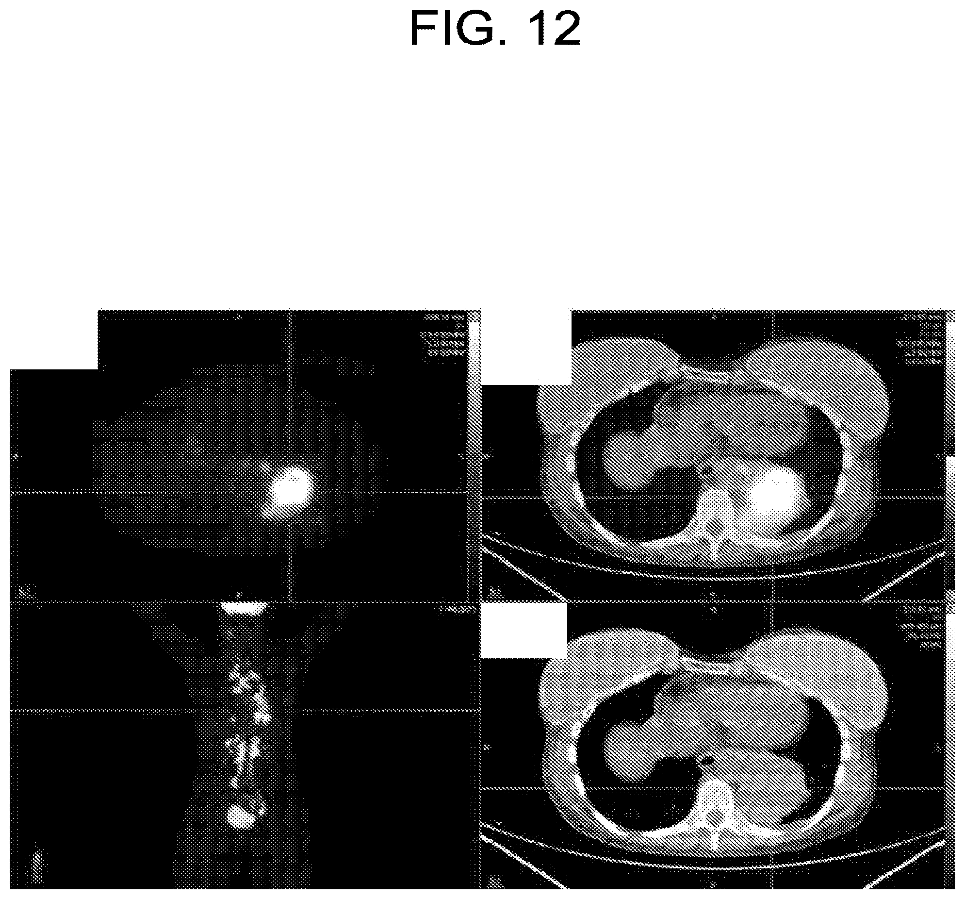 Patent US12102613 Figure 13 – Compositions, methods, systems and/or kits for preventing and/or treating neoplasms