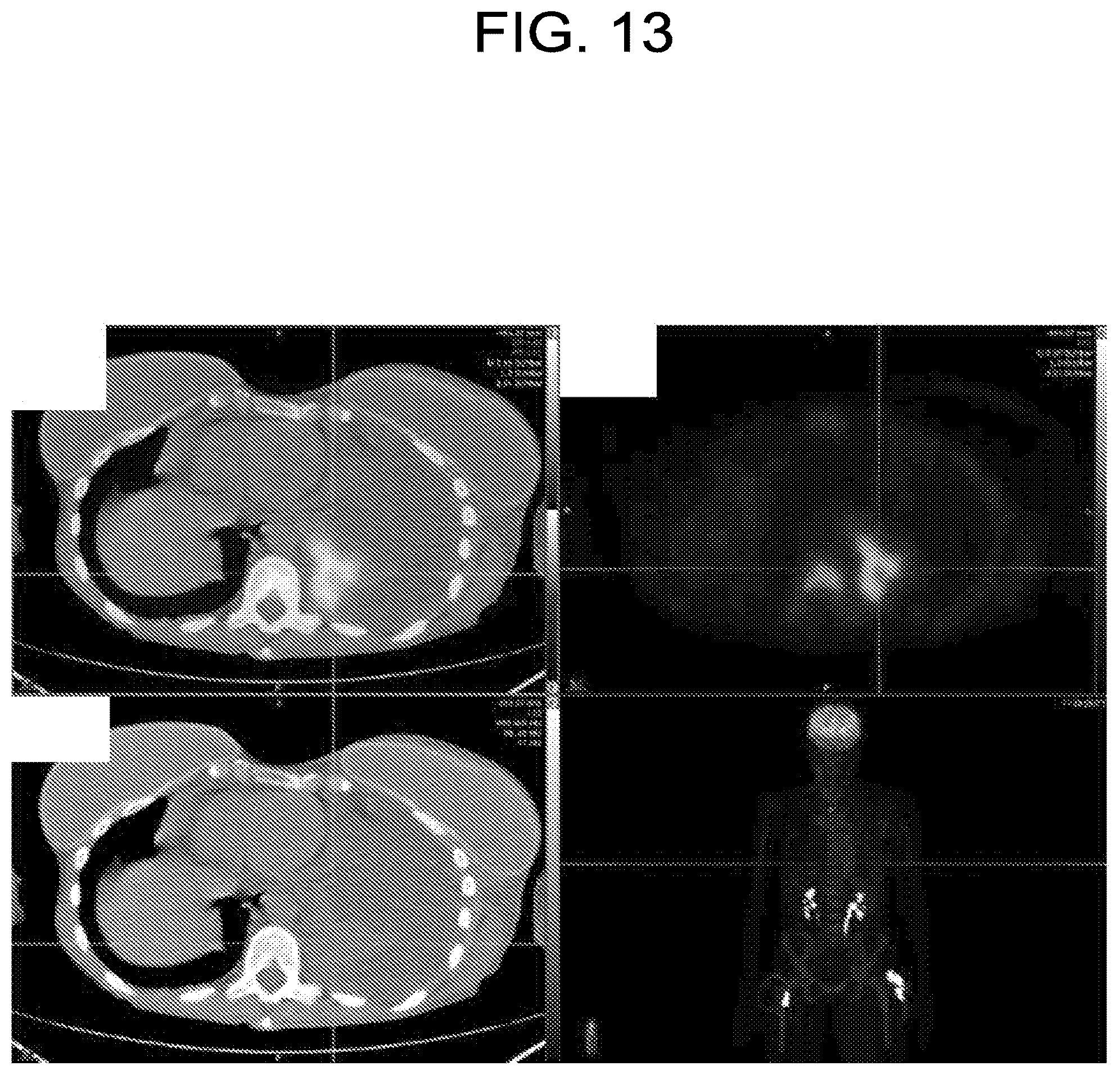 Patent US12102613 Figure 14 – Compositions, methods, systems and/or kits for preventing and/or treating neoplasms