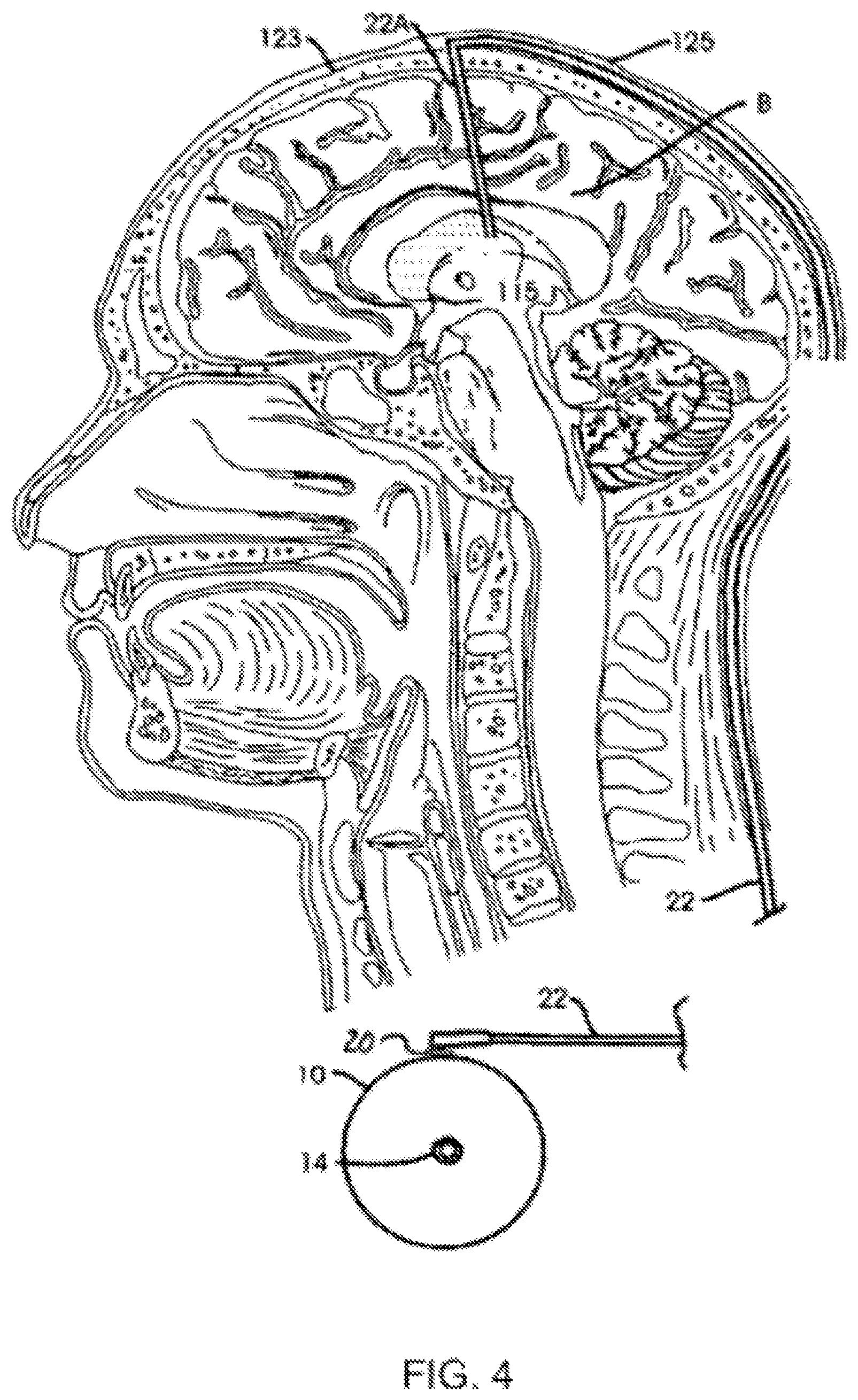 Patent US12102636 Figure 4 – Administration of antipsychotics