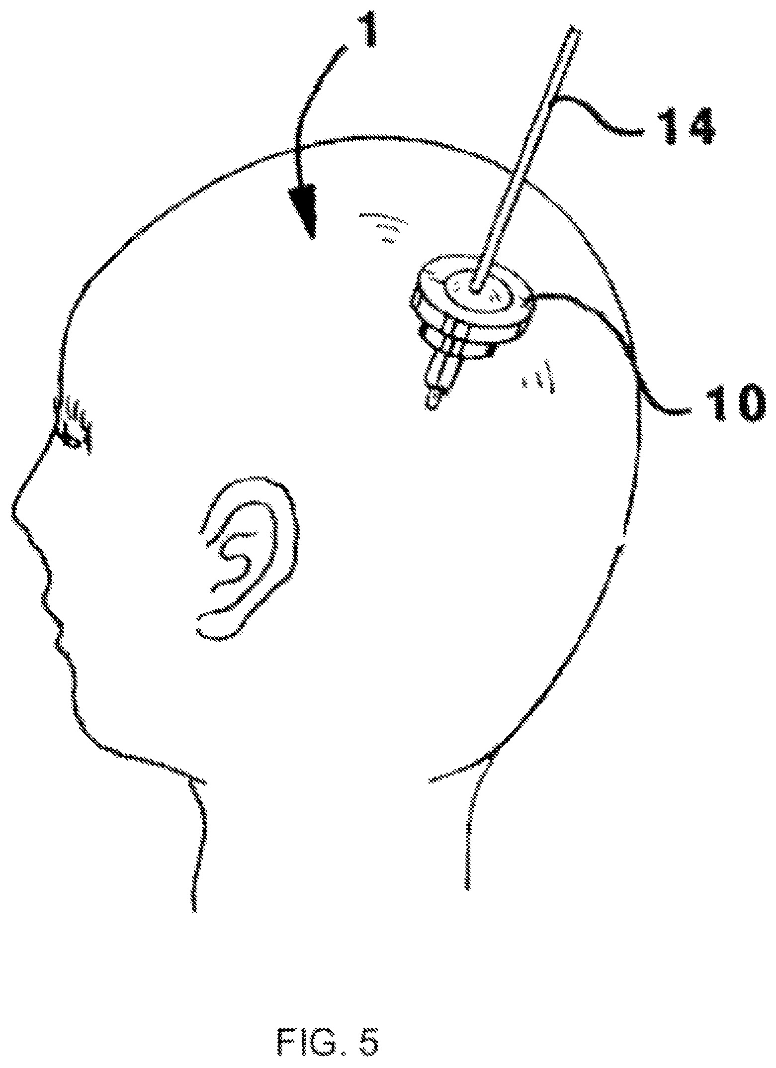 Patent US12102636 Figure 5 – Administration of antipsychotics