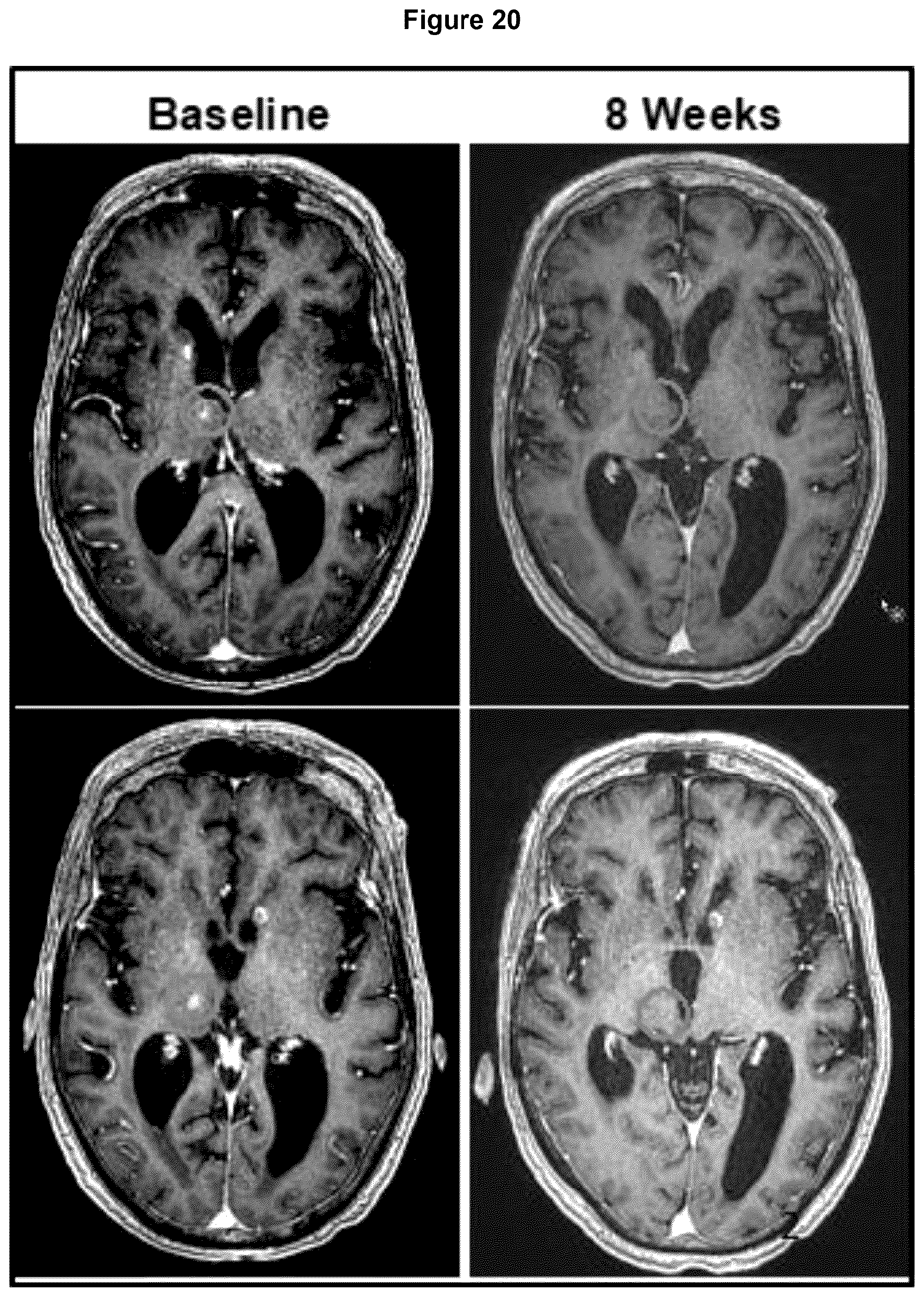 Patent US12102639 Figure 18 – Imipridones for gliomas