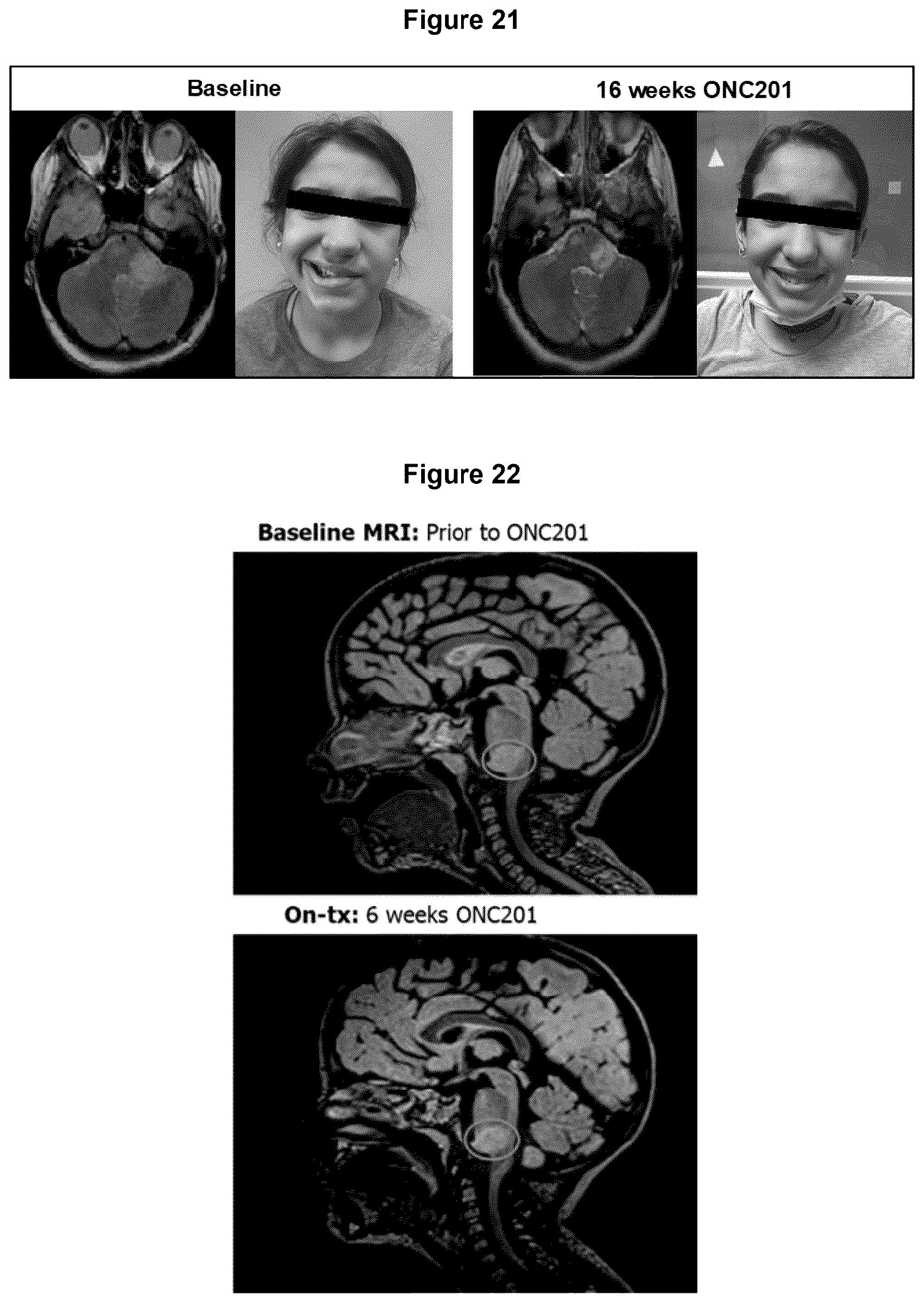 Patent US12102639 Figure 19 – Imipridones for gliomas