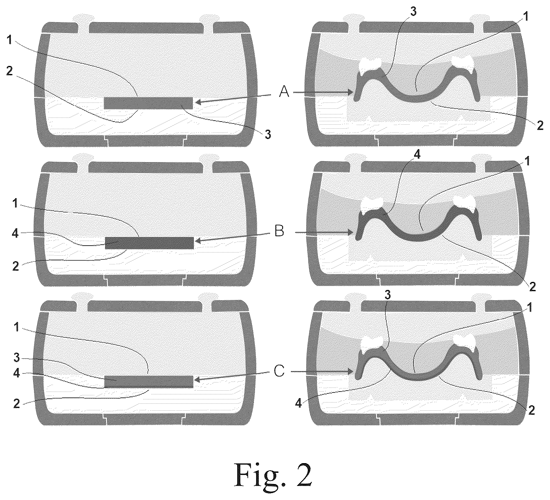 Patent US12102697 Figure 4 – Method of reducing bacterial activity in the oral cavity of a patient