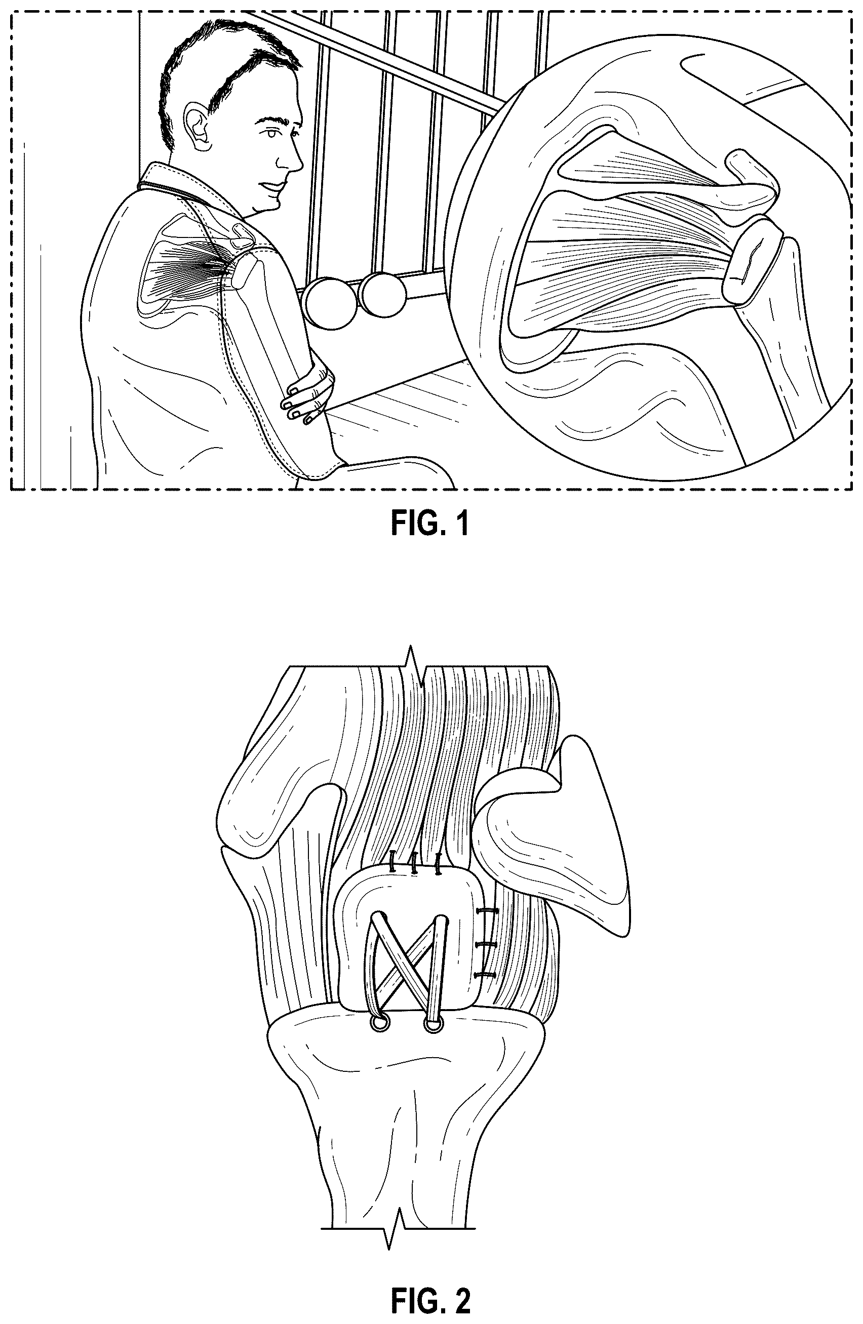 Patent US12102731 Figure 1 – Port-accessible multidirectional reinforced minimally invasive collagen device for soft tissue repair