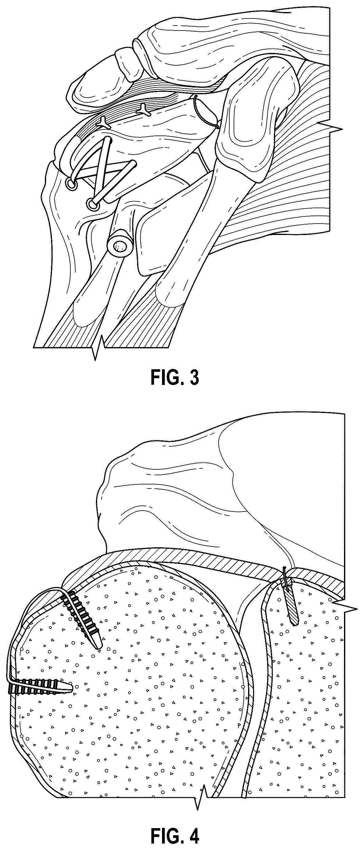 Patent US12102731 Figure 2 – Port-accessible multidirectional reinforced minimally invasive collagen device for soft tissue repair