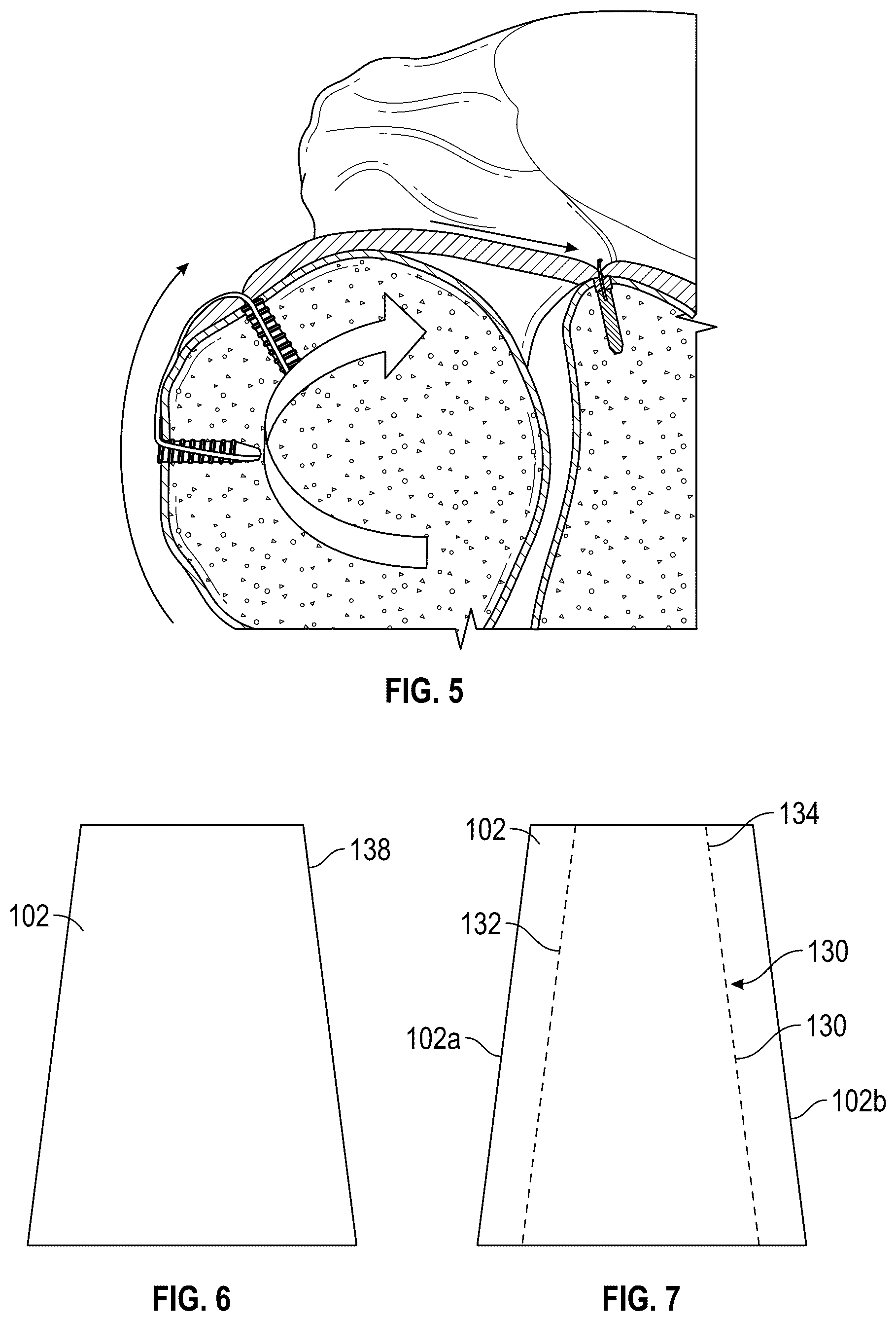 Patent US12102731 Figure 3 – Port-accessible multidirectional reinforced minimally invasive collagen device for soft tissue repair