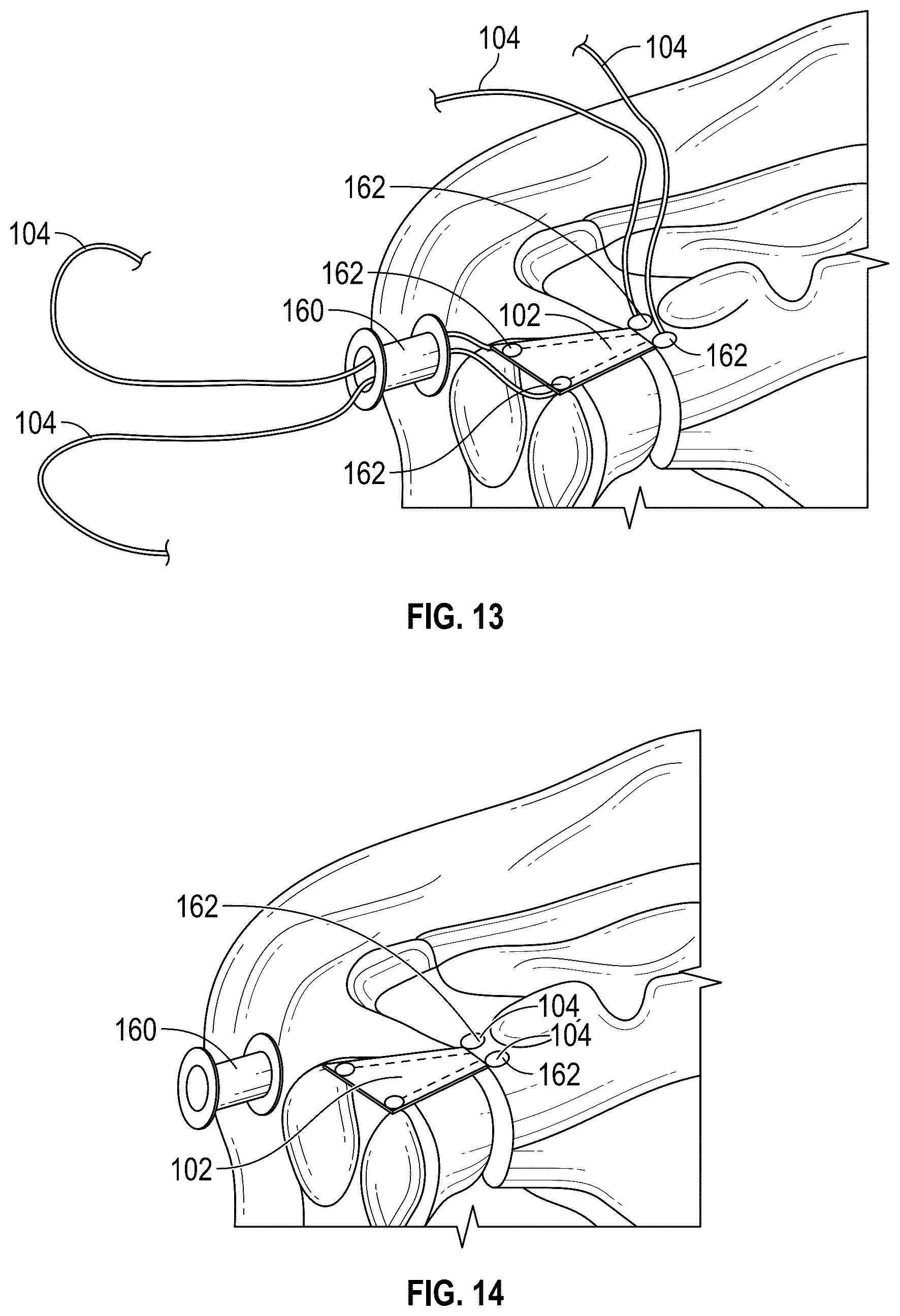 Patent US12102731 Figure 7 – Port-accessible multidirectional reinforced minimally invasive collagen device for soft tissue repair