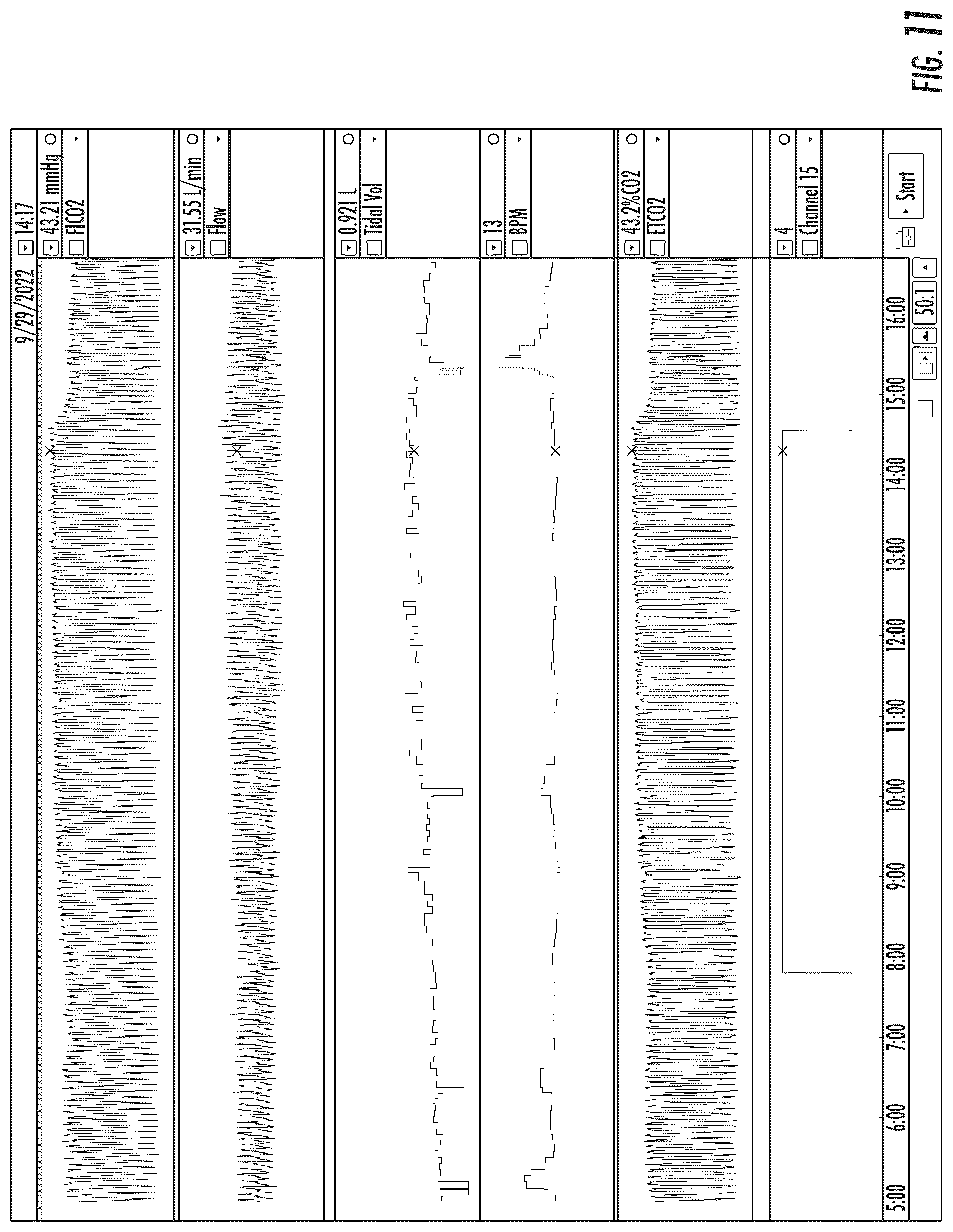 Patent US12102758 Figure 11 – Method and system for treating central sleep apnea