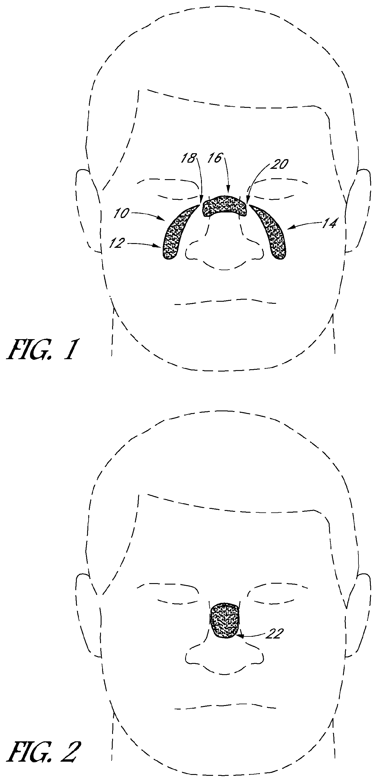 Patent US12102759 Figure 1 – Sealing force detection enabled, therapeutic fluid delivery device