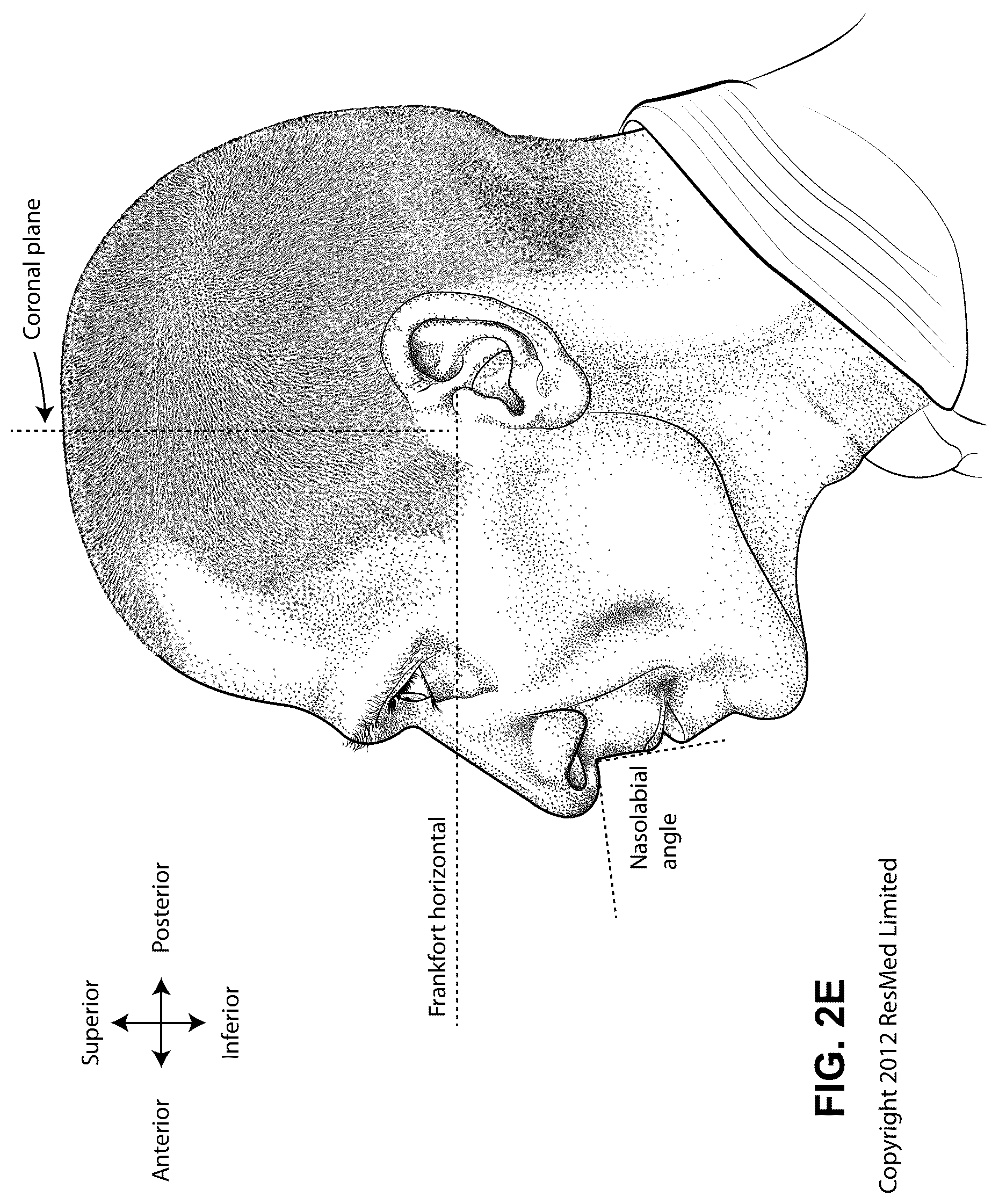 Patent US12102760 Figure 8 – Patient interface