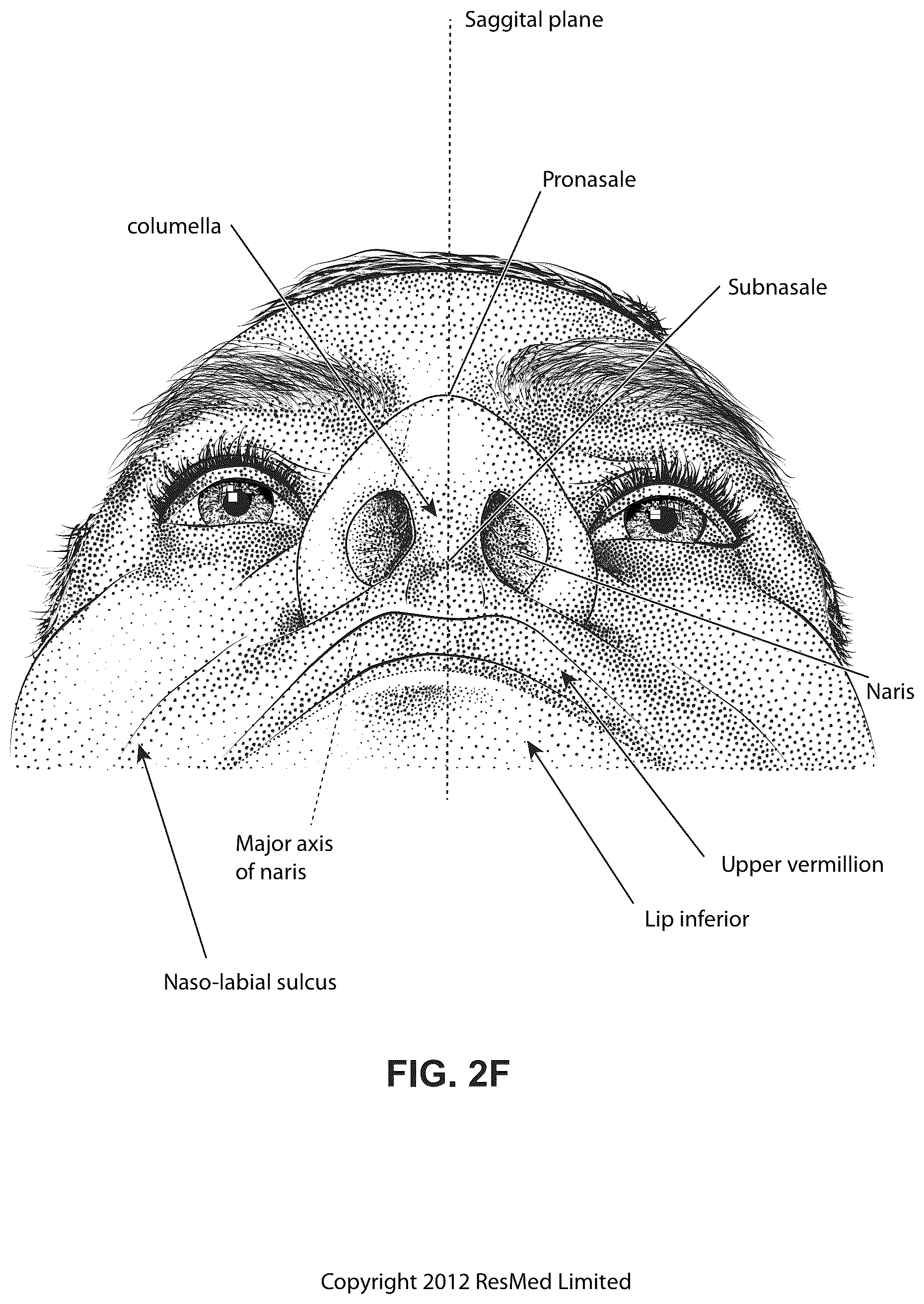 Patent US12102760 Figure 9 – Patient interface