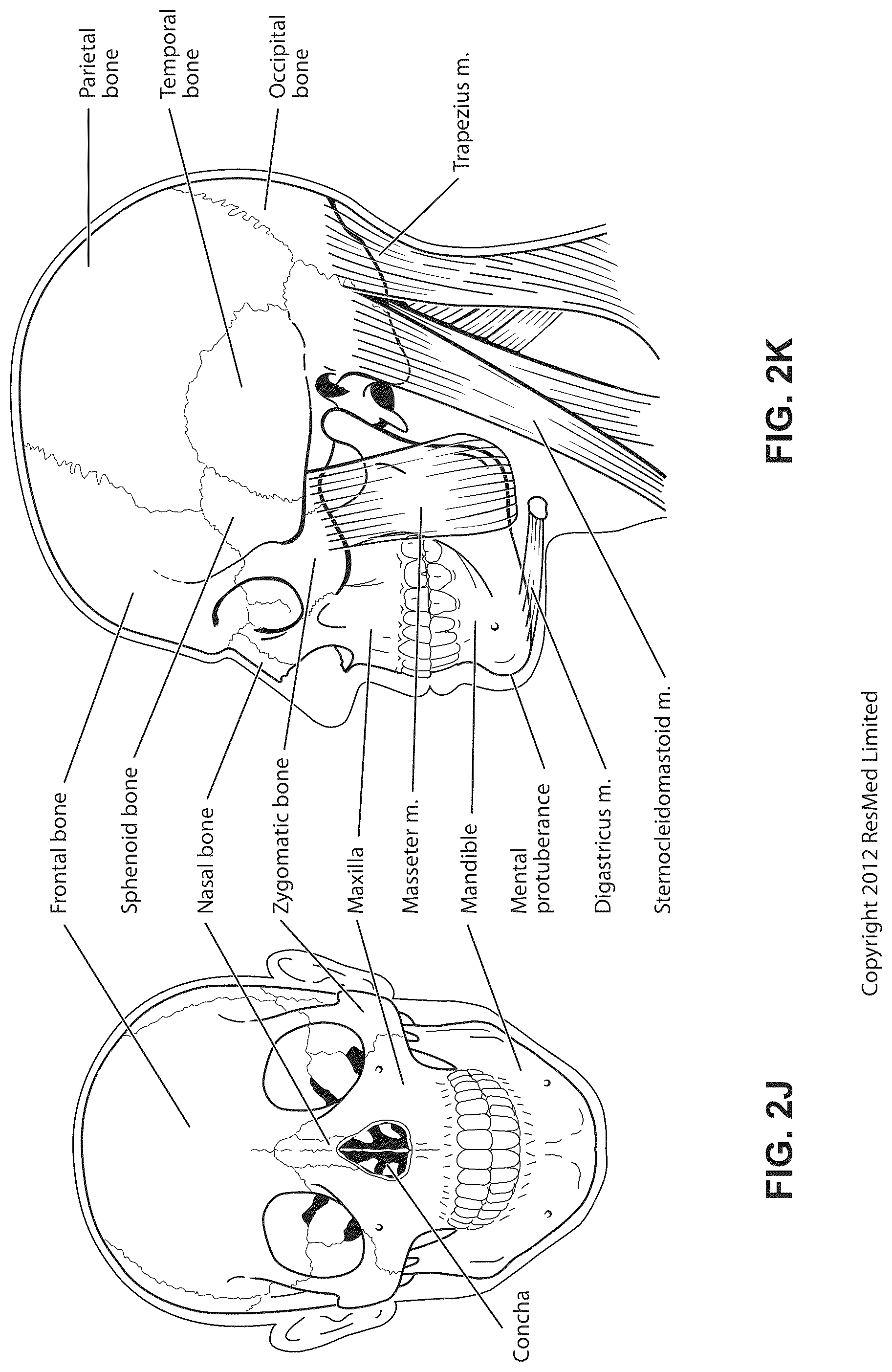 Patent US12102760 Figure 11 – Patient interface