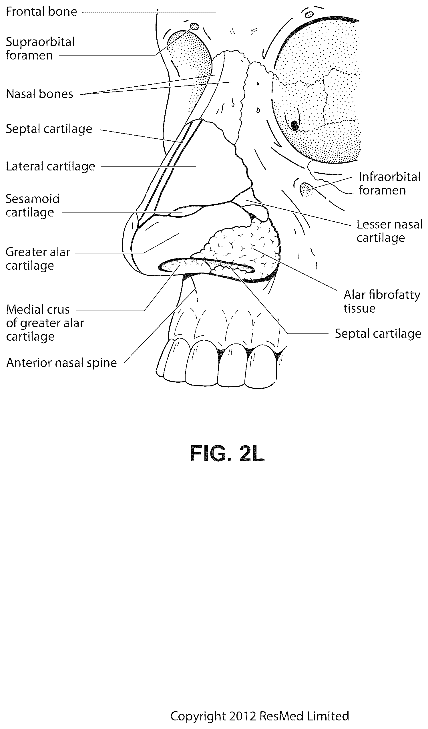 Patent US12102760 Figure 12 – Patient interface