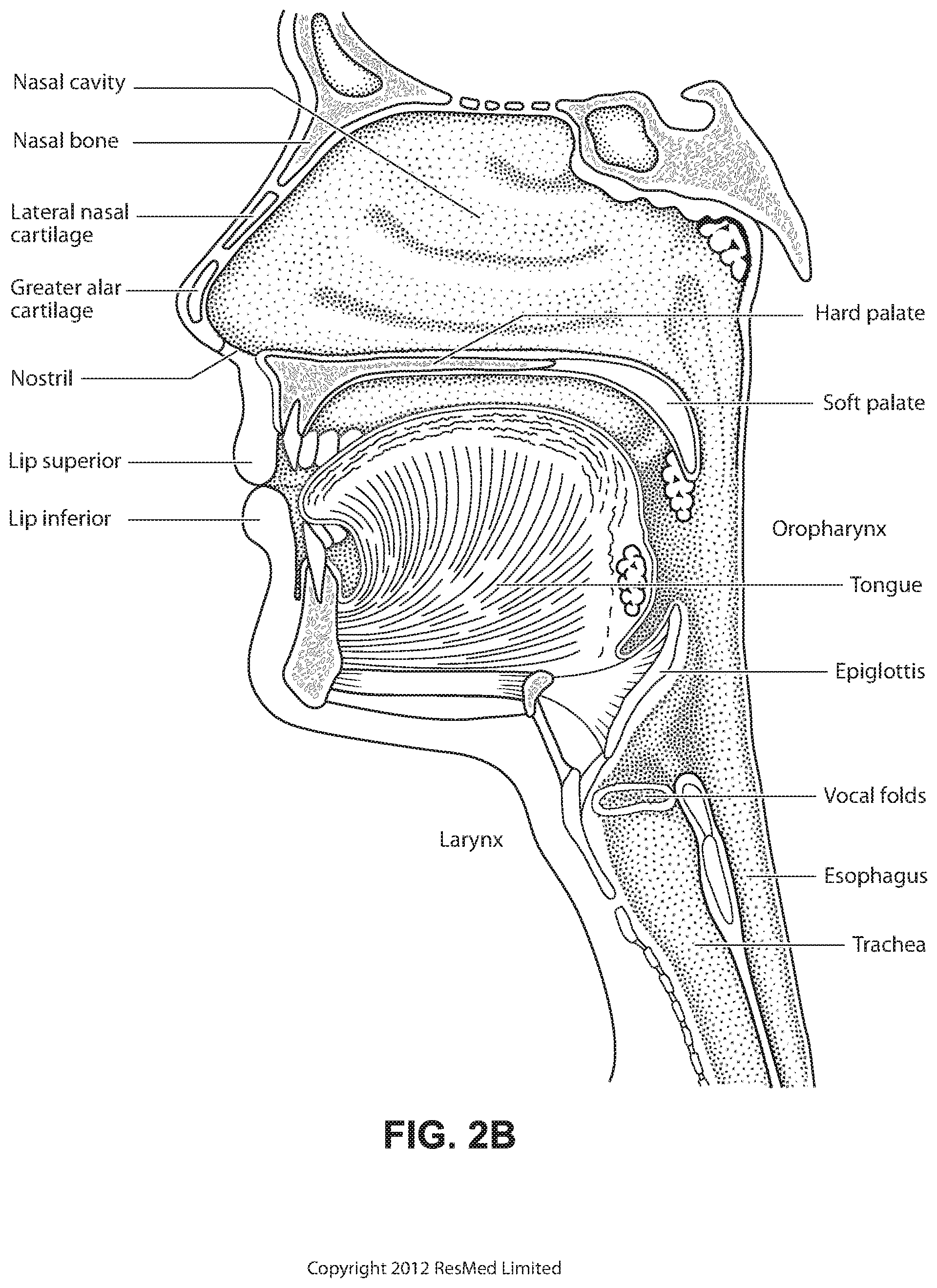 Patent US12102766 Figure 5 – Vent adaptor for patient interface system