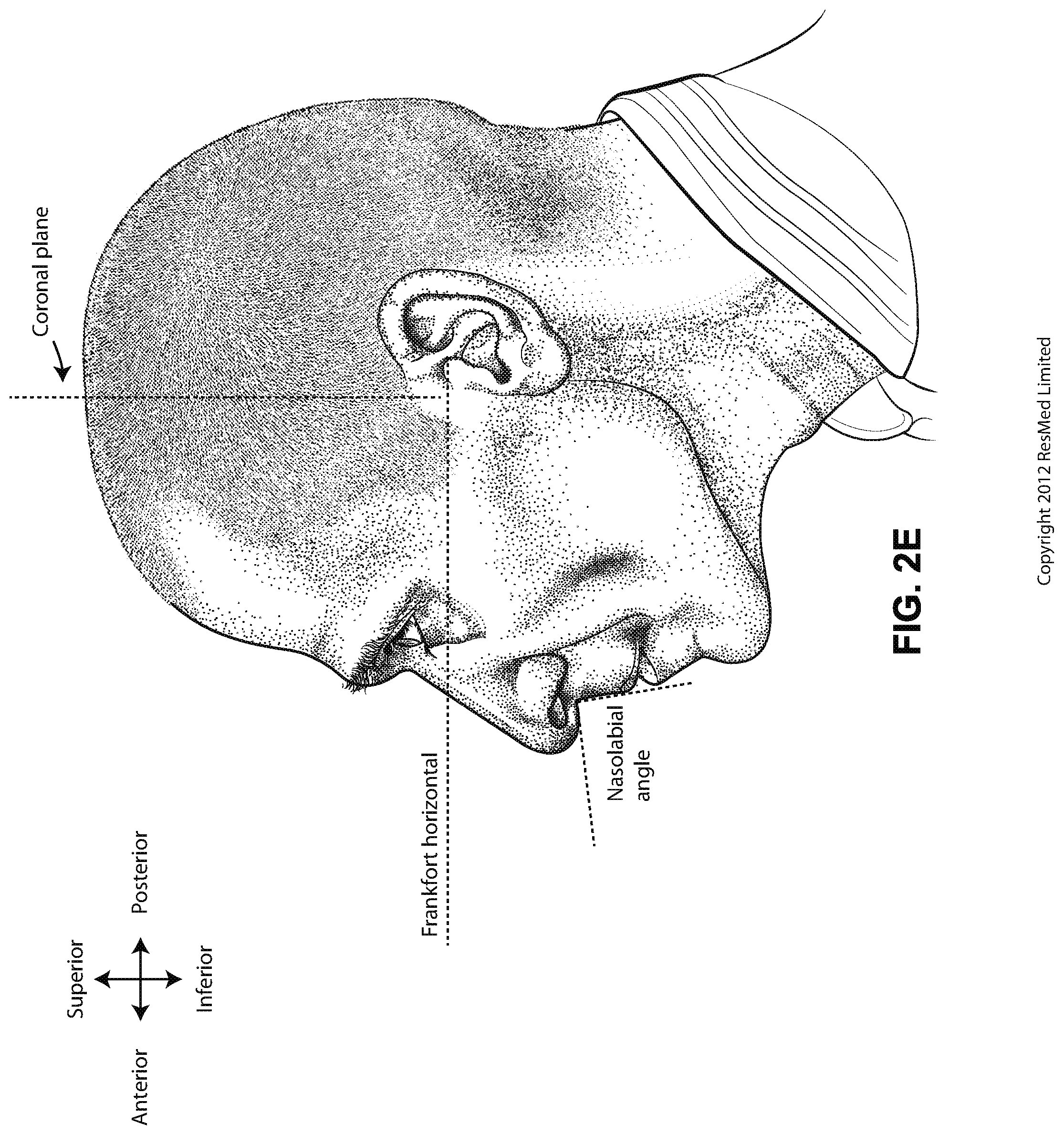 Patent US12102766 Figure 8 – Vent adaptor for patient interface system