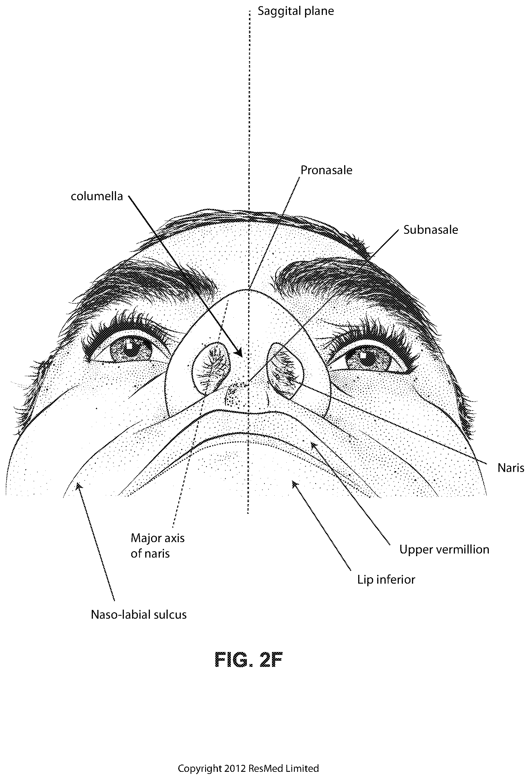Patent US12102766 Figure 9 – Vent adaptor for patient interface system