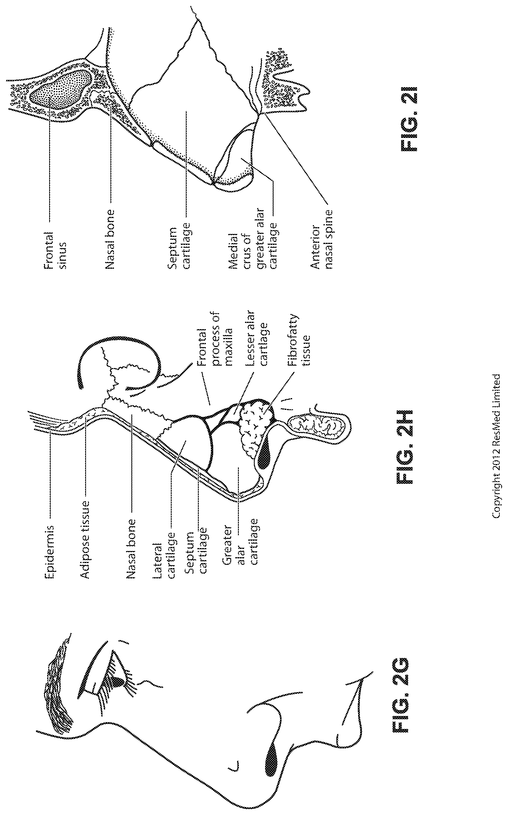 Patent US12102766 Figure 10 – Vent adaptor for patient interface system