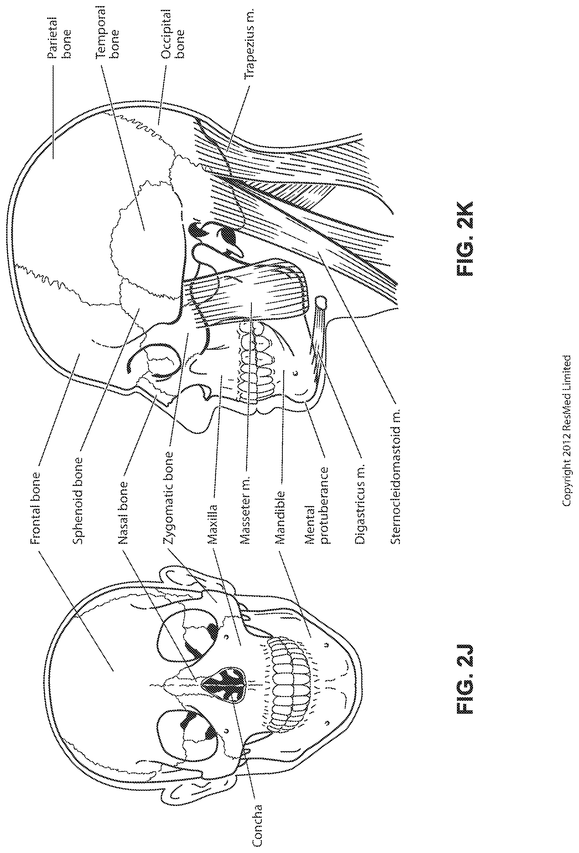 Patent US12102766 Figure 11 – Vent adaptor for patient interface system