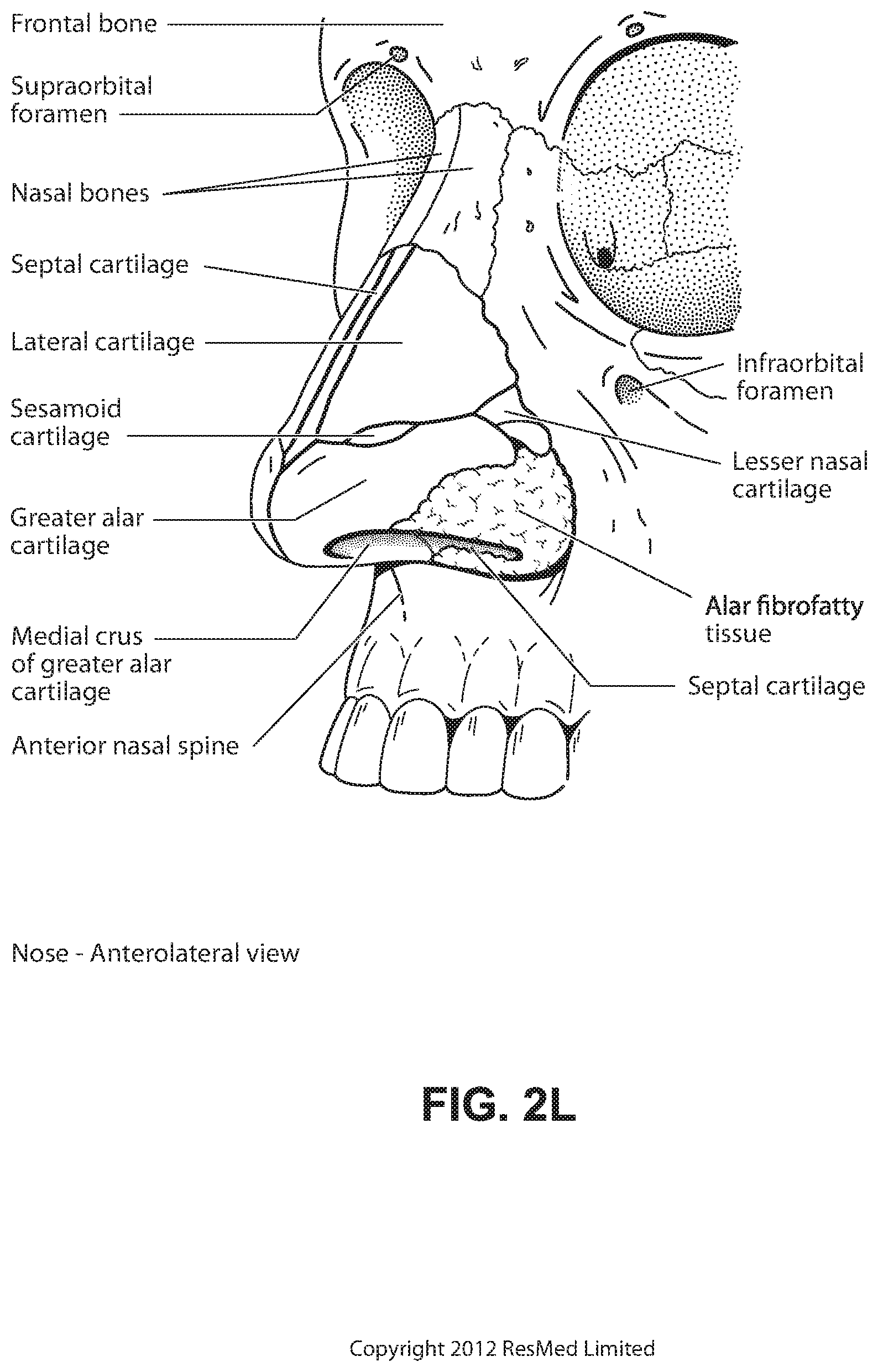 Patent US12102766 Figure 12 – Vent adaptor for patient interface system