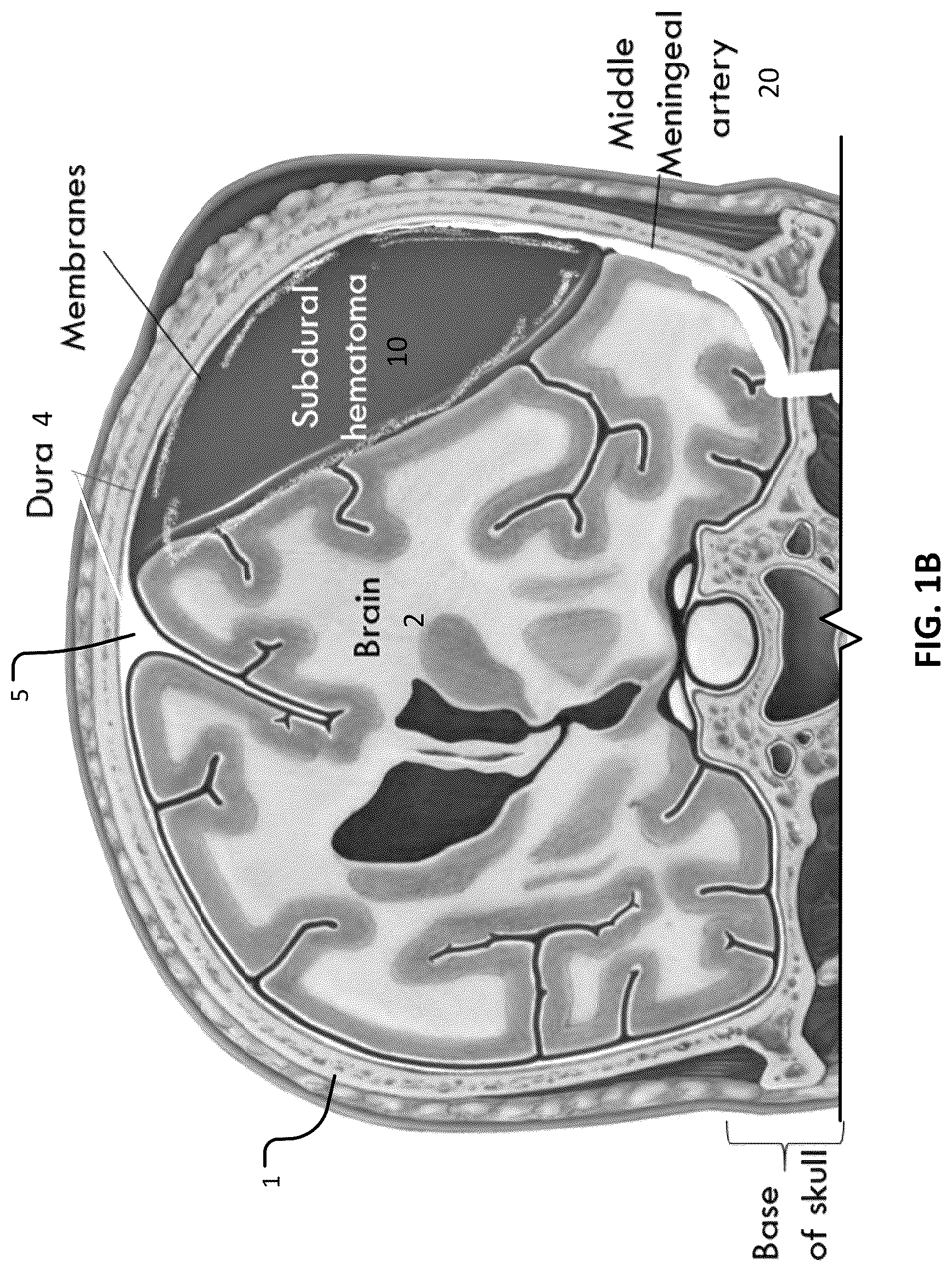 Patent US12102777 Figure 2 – Devices and methods for transvascular drainage of fluids in an intracranial extravascular space