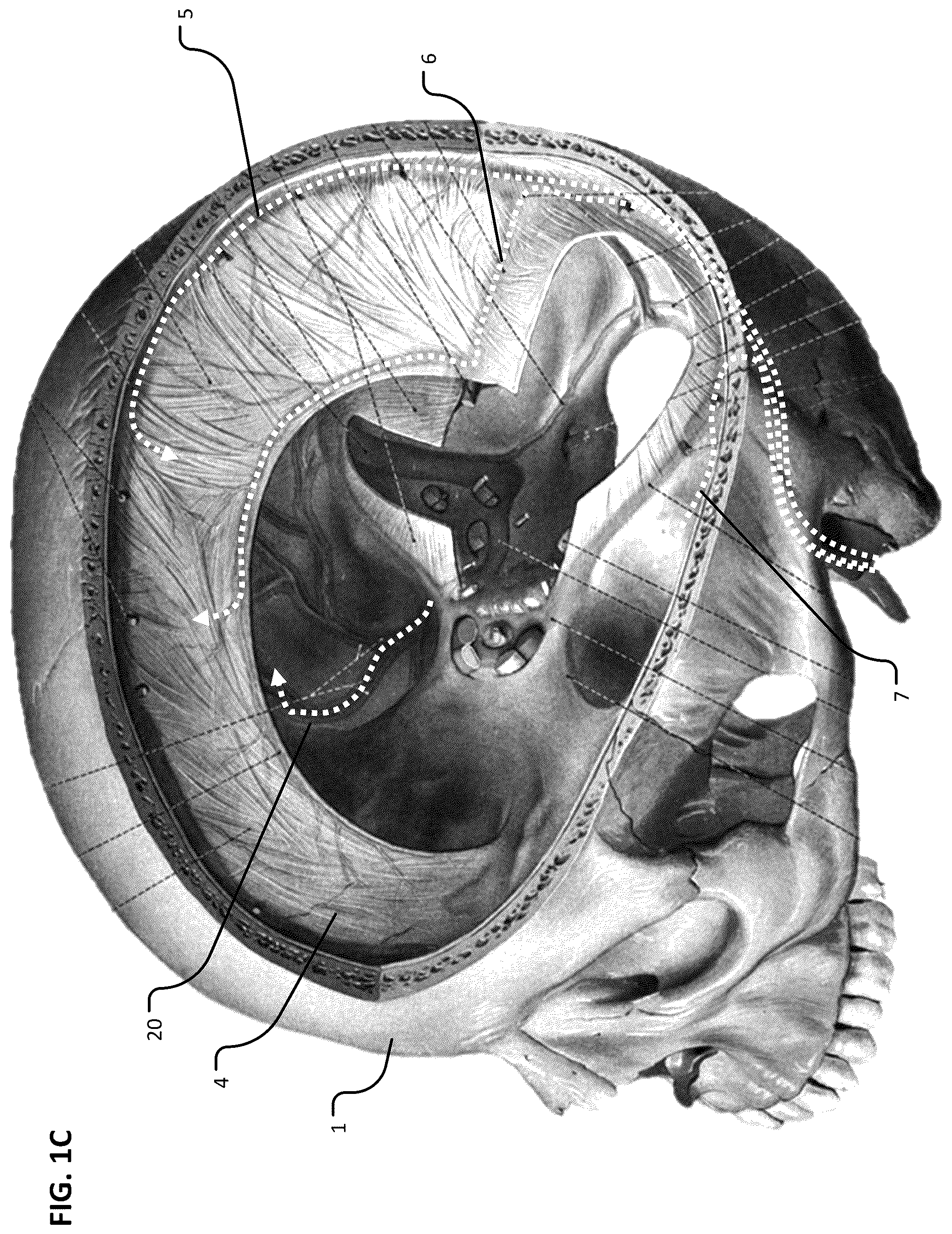 Patent US12102777 Figure 3 – Devices and methods for transvascular drainage of fluids in an intracranial extravascular space