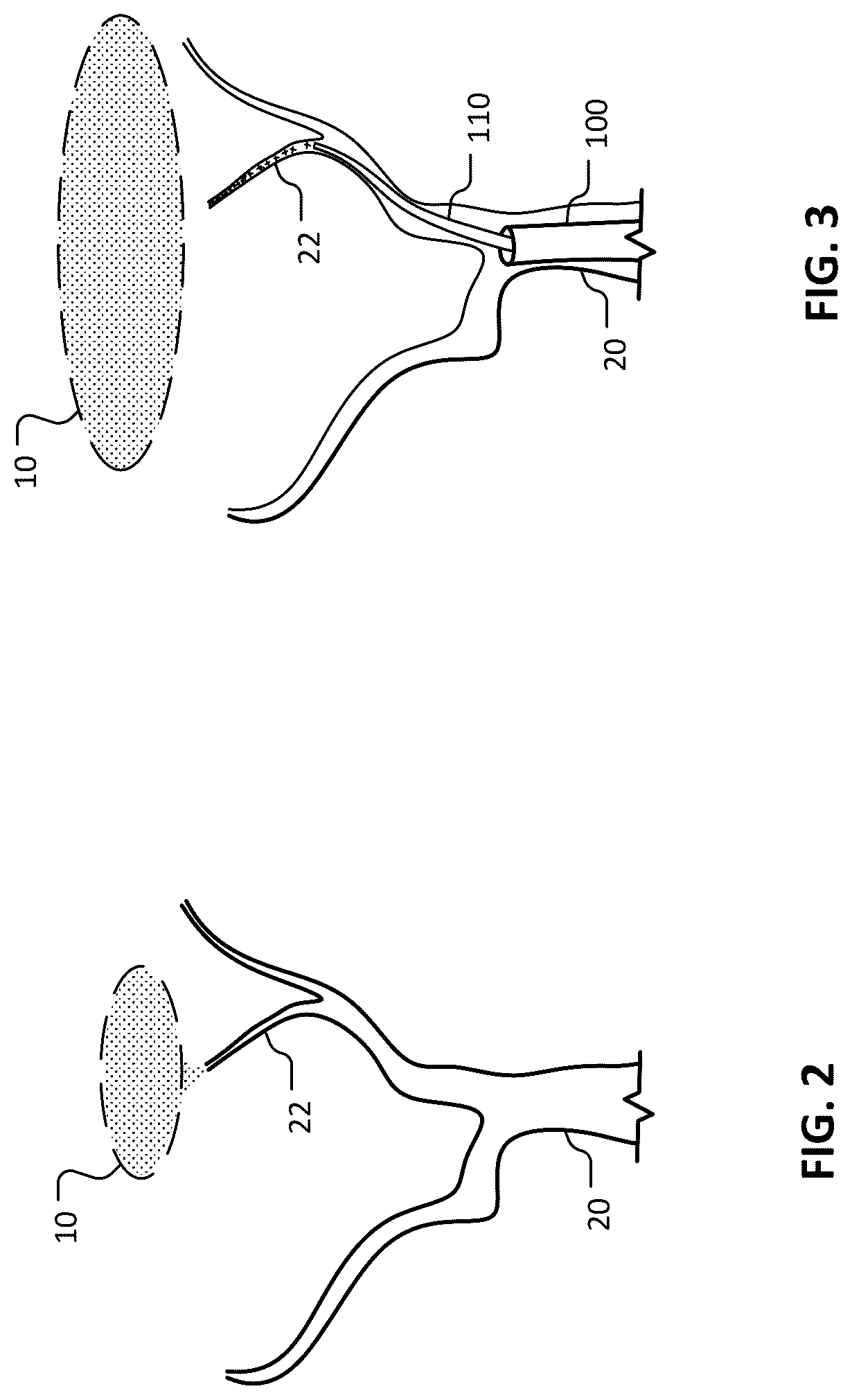 Patent US12102777 Figure 5 – Devices and methods for transvascular drainage of fluids in an intracranial extravascular space