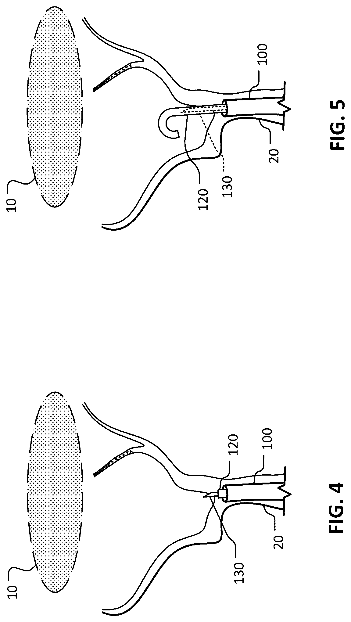 Patent US12102777 Figure 6 – Devices and methods for transvascular drainage of fluids in an intracranial extravascular space