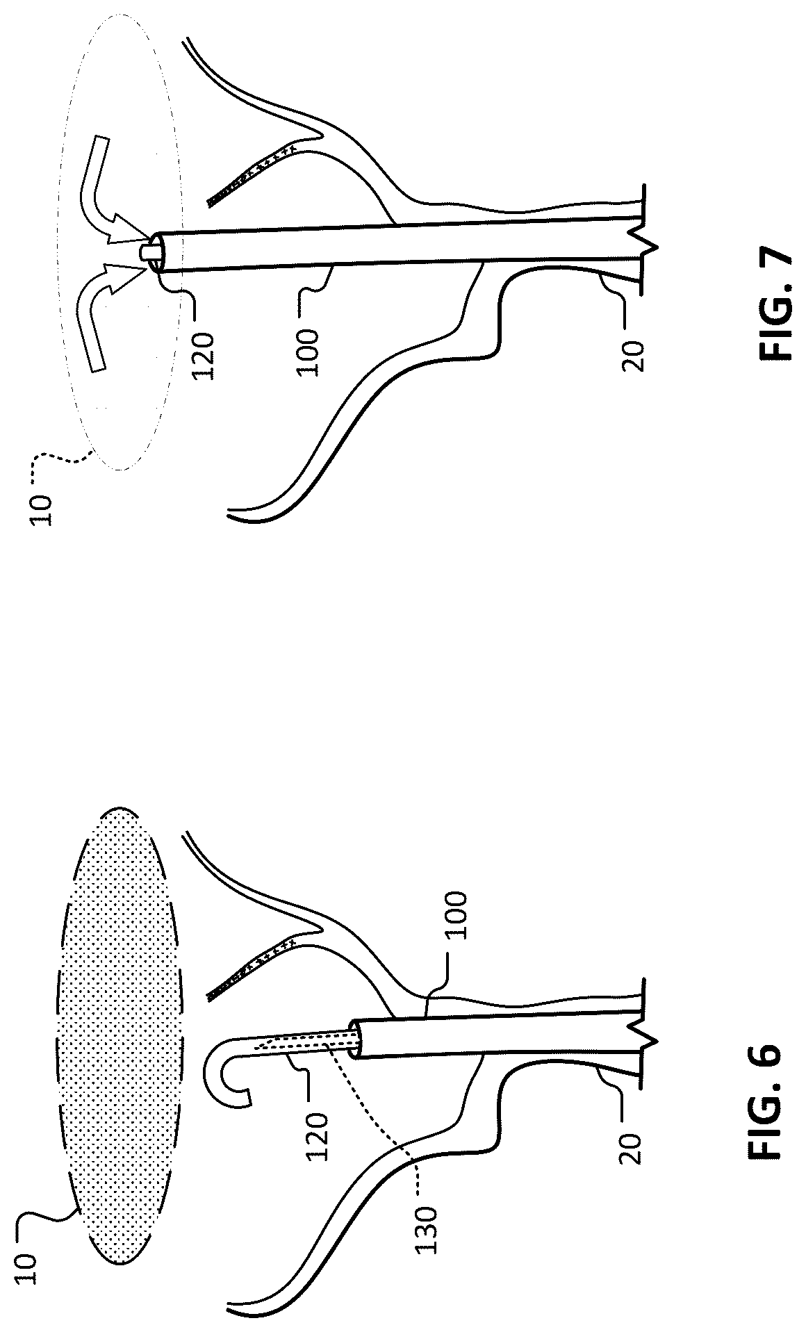 Patent US12102777 Figure 7 – Devices and methods for transvascular drainage of fluids in an intracranial extravascular space