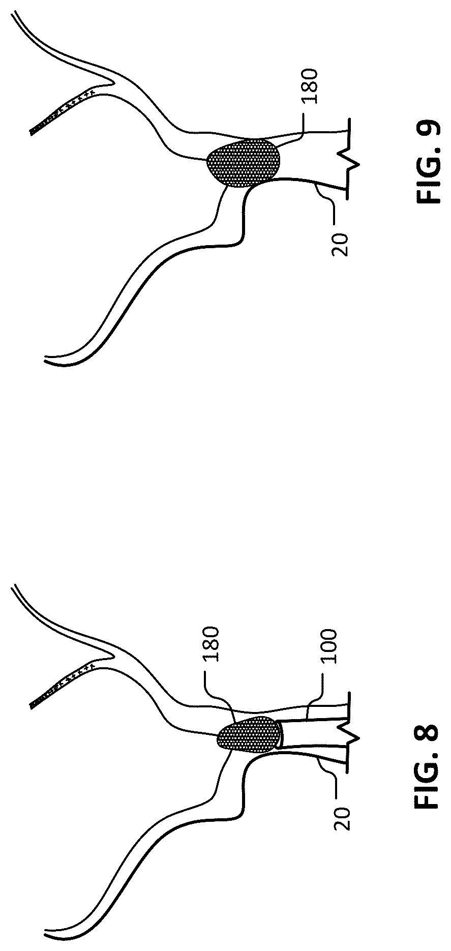 Patent US12102777 Figure 8 – Devices and methods for transvascular drainage of fluids in an intracranial extravascular space