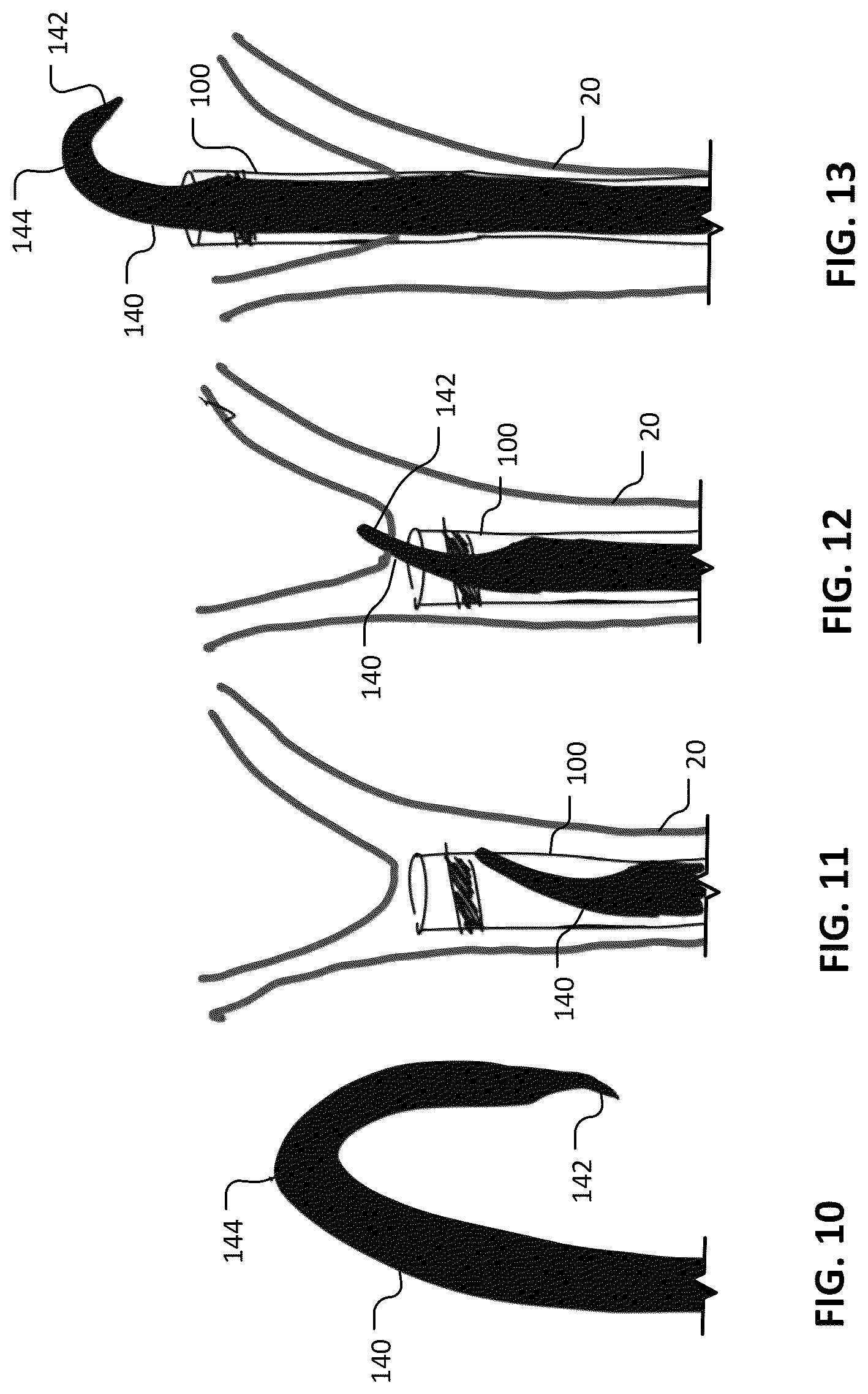 Patent US12102777 Figure 9 – Devices and methods for transvascular drainage of fluids in an intracranial extravascular space