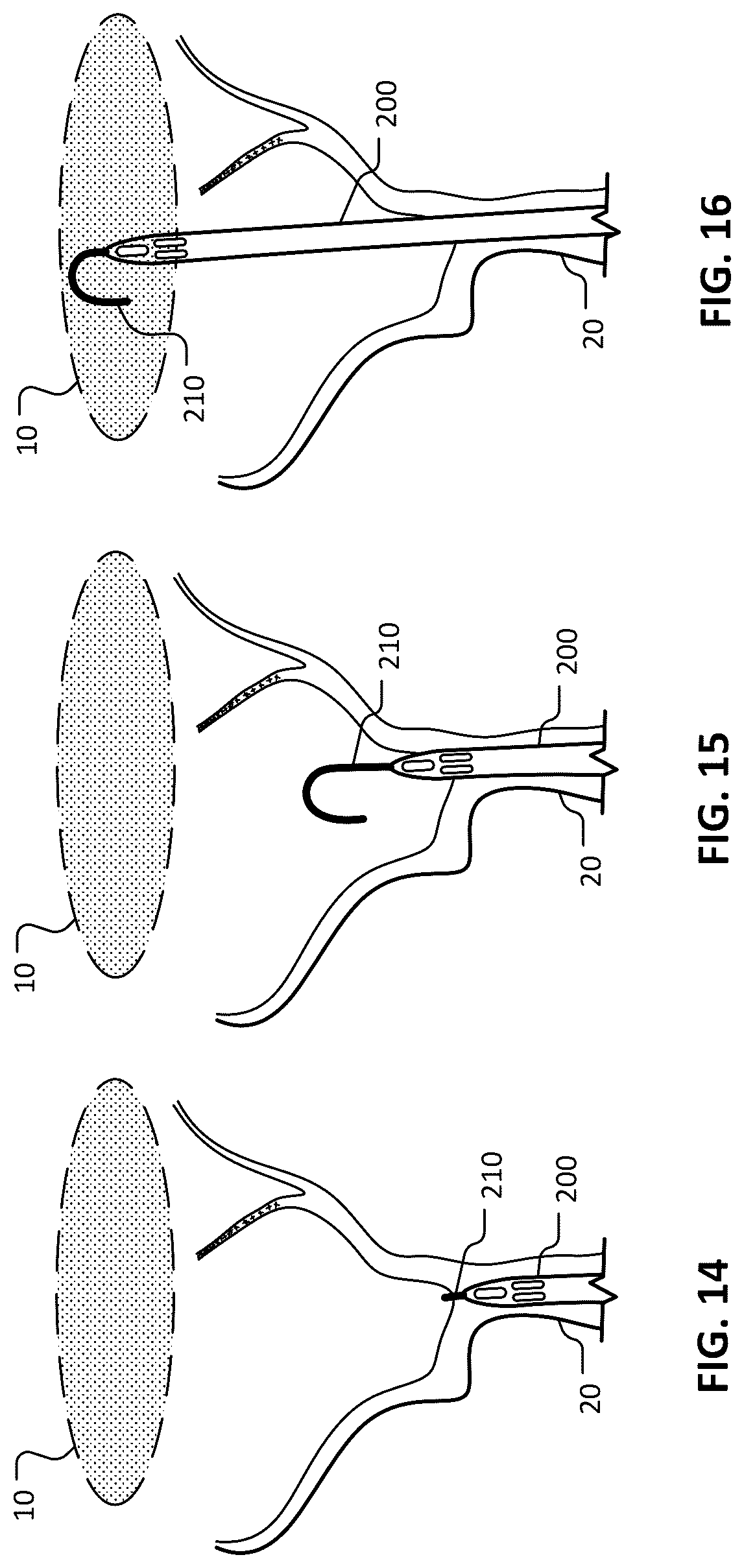 Patent US12102777 Figure 10 – Devices and methods for transvascular drainage of fluids in an intracranial extravascular space