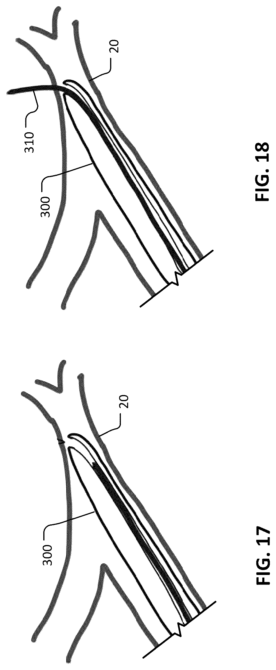 Patent US12102777 Figure 11 – Devices and methods for transvascular drainage of fluids in an intracranial extravascular space