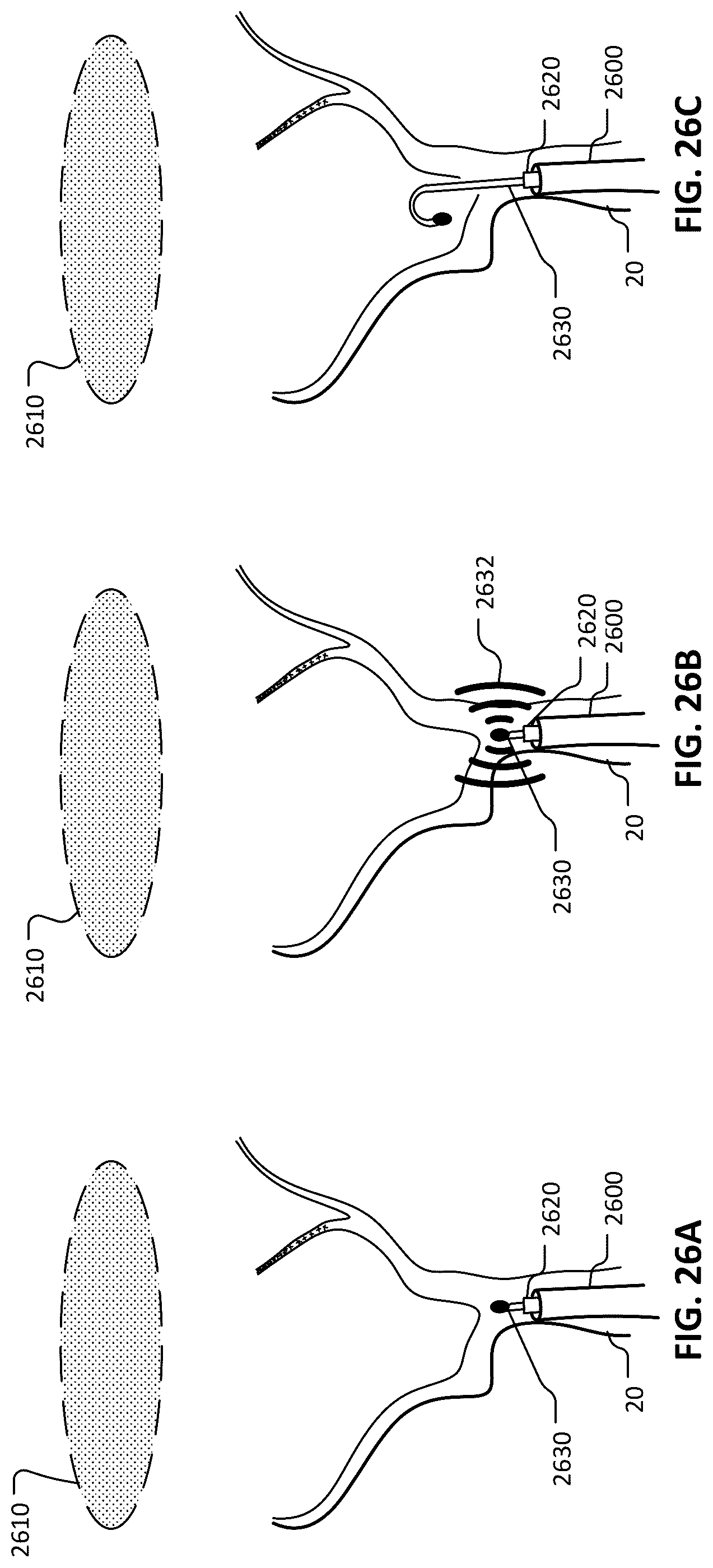 Patent US12102777 Figure 19 – Devices and methods for transvascular drainage of fluids in an intracranial extravascular space