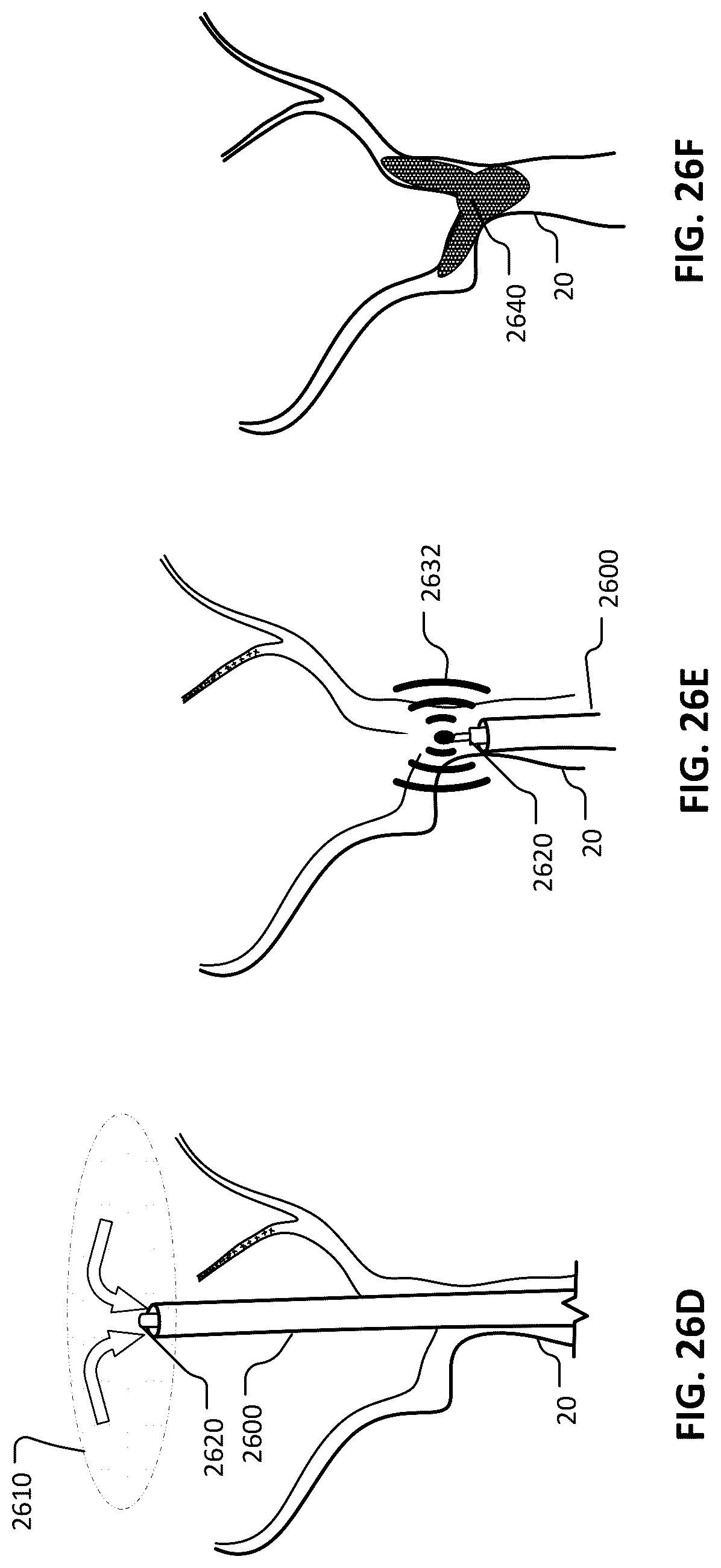 Patent US12102777 Figure 20 – Devices and methods for transvascular drainage of fluids in an intracranial extravascular space