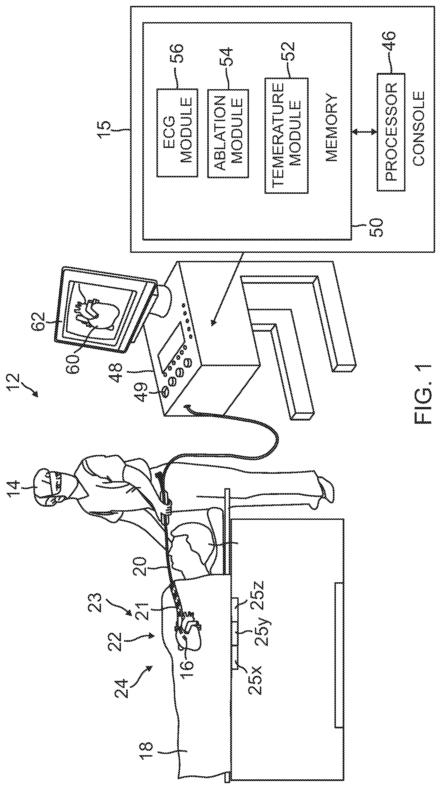 Patent US12102781 Figure 1 – Reinforcement for irrigated electrophysiology balloon catheter with flexible-circuit electrodes