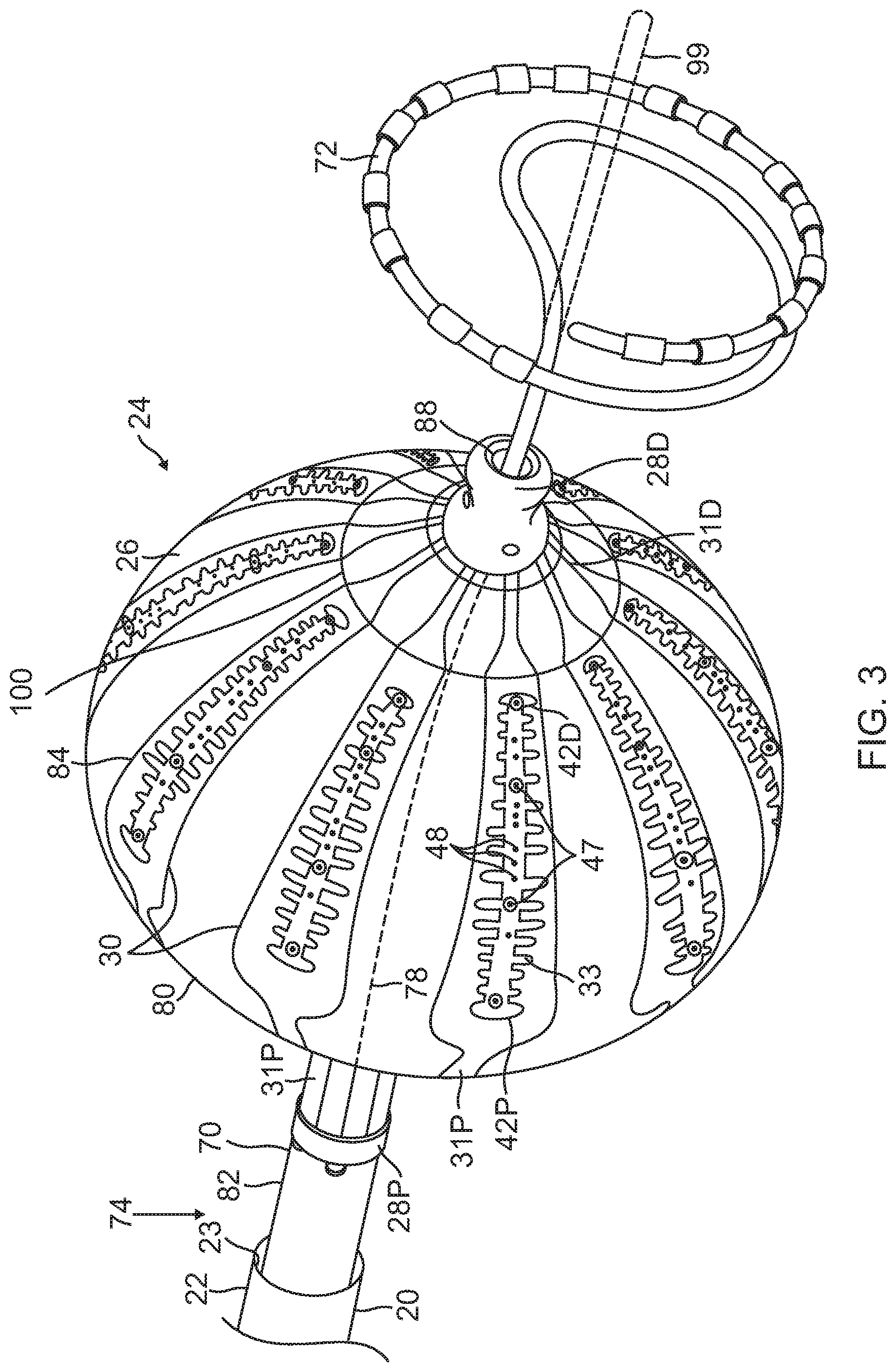 Patent US12102781 Figure 3 – Reinforcement for irrigated electrophysiology balloon catheter with flexible-circuit electrodes