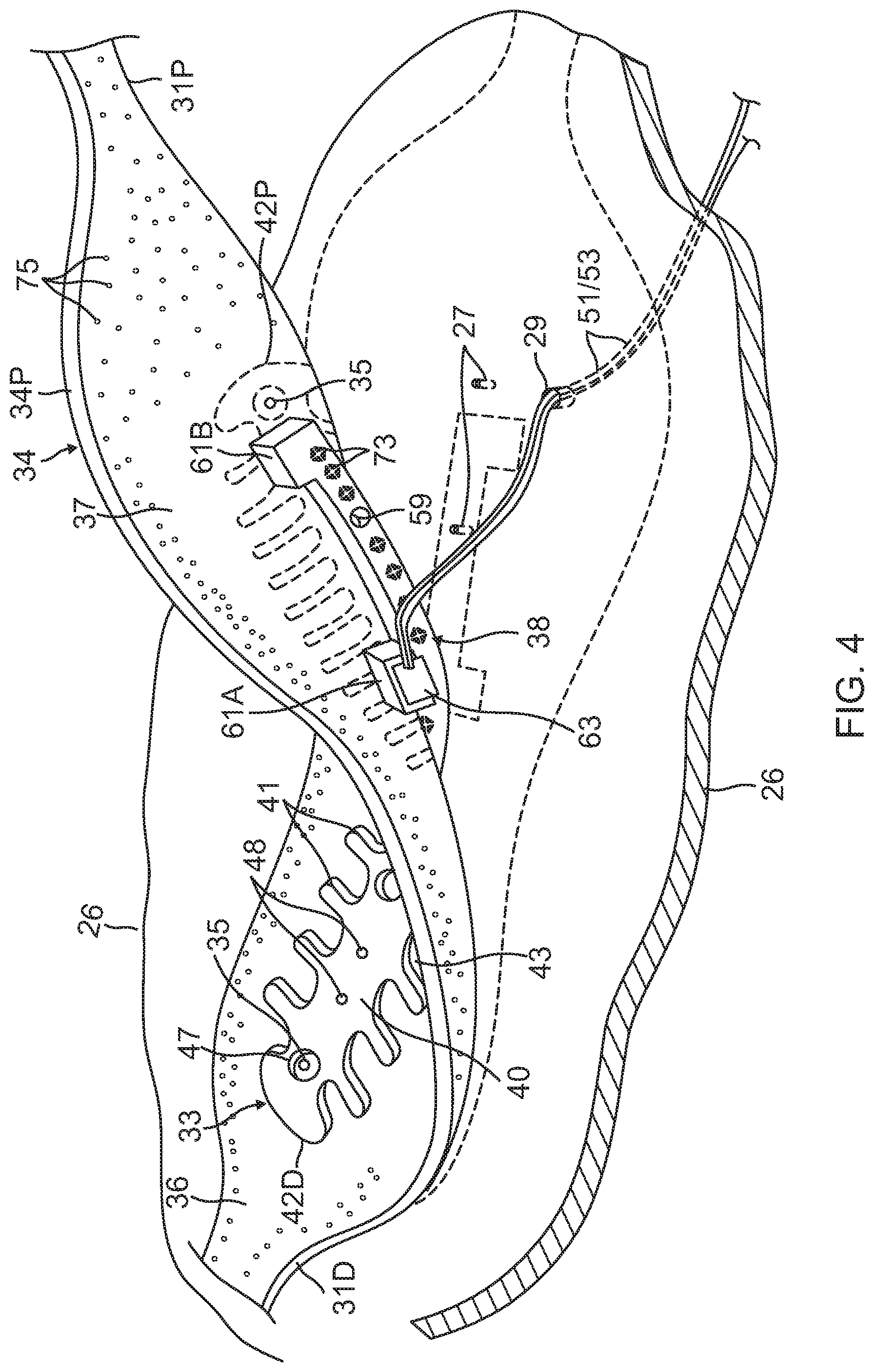 Patent US12102781 Figure 4 – Reinforcement for irrigated electrophysiology balloon catheter with flexible-circuit electrodes