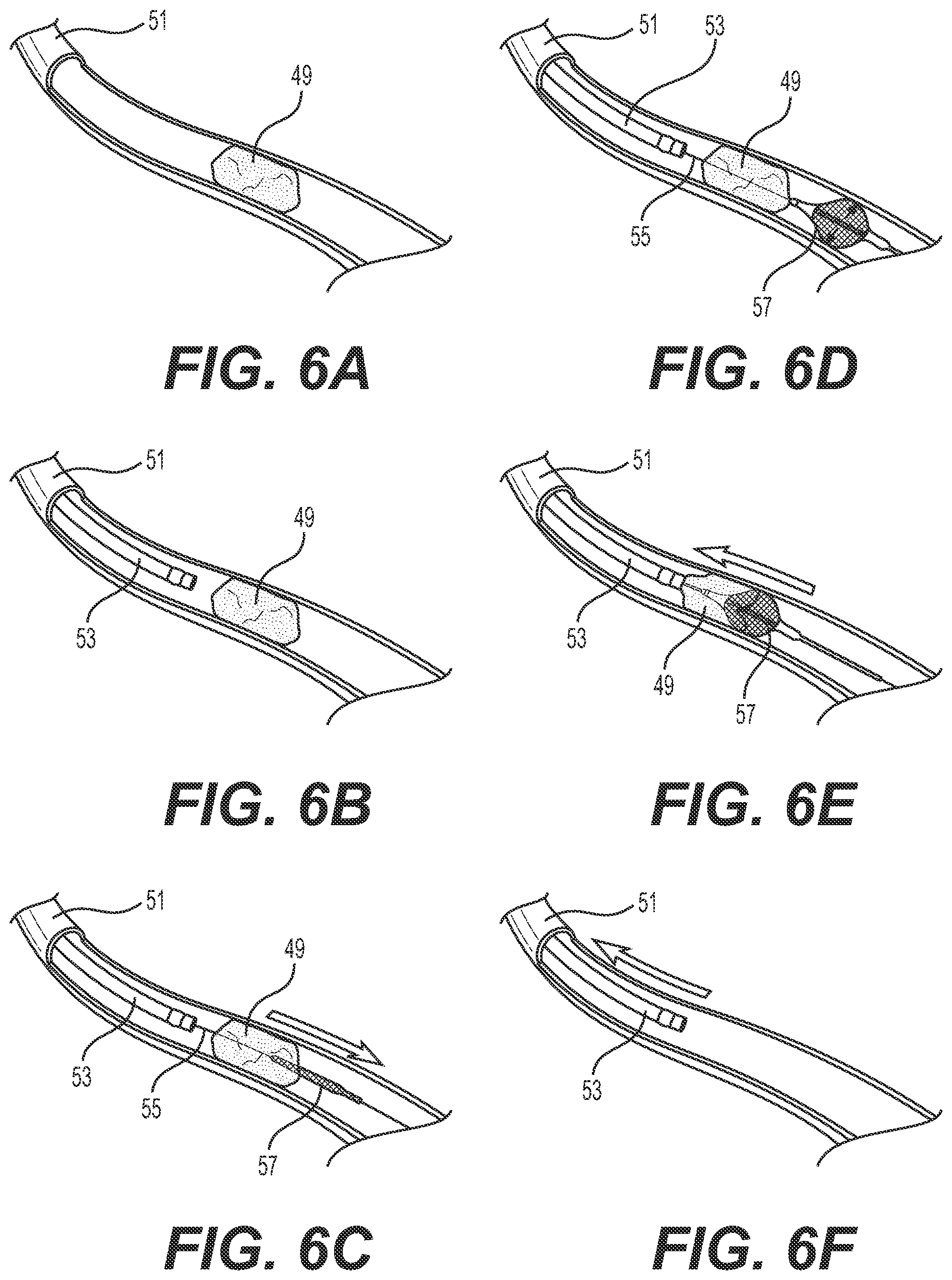 Patent US12102782 Figure 8 – Thrombectomy and aspiration system and methods of use