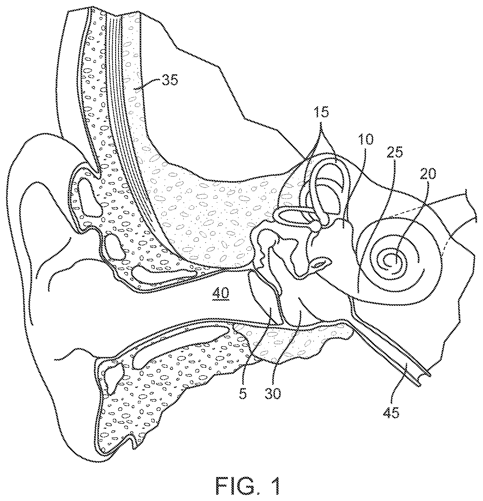 Patent US12102785 Figure 1 – Inner ear drug delivery devices and methods of use