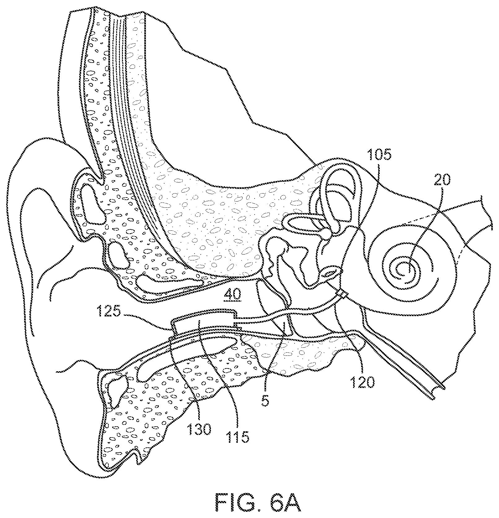 Patent US12102785 Figure 6 – Inner ear drug delivery devices and methods of use