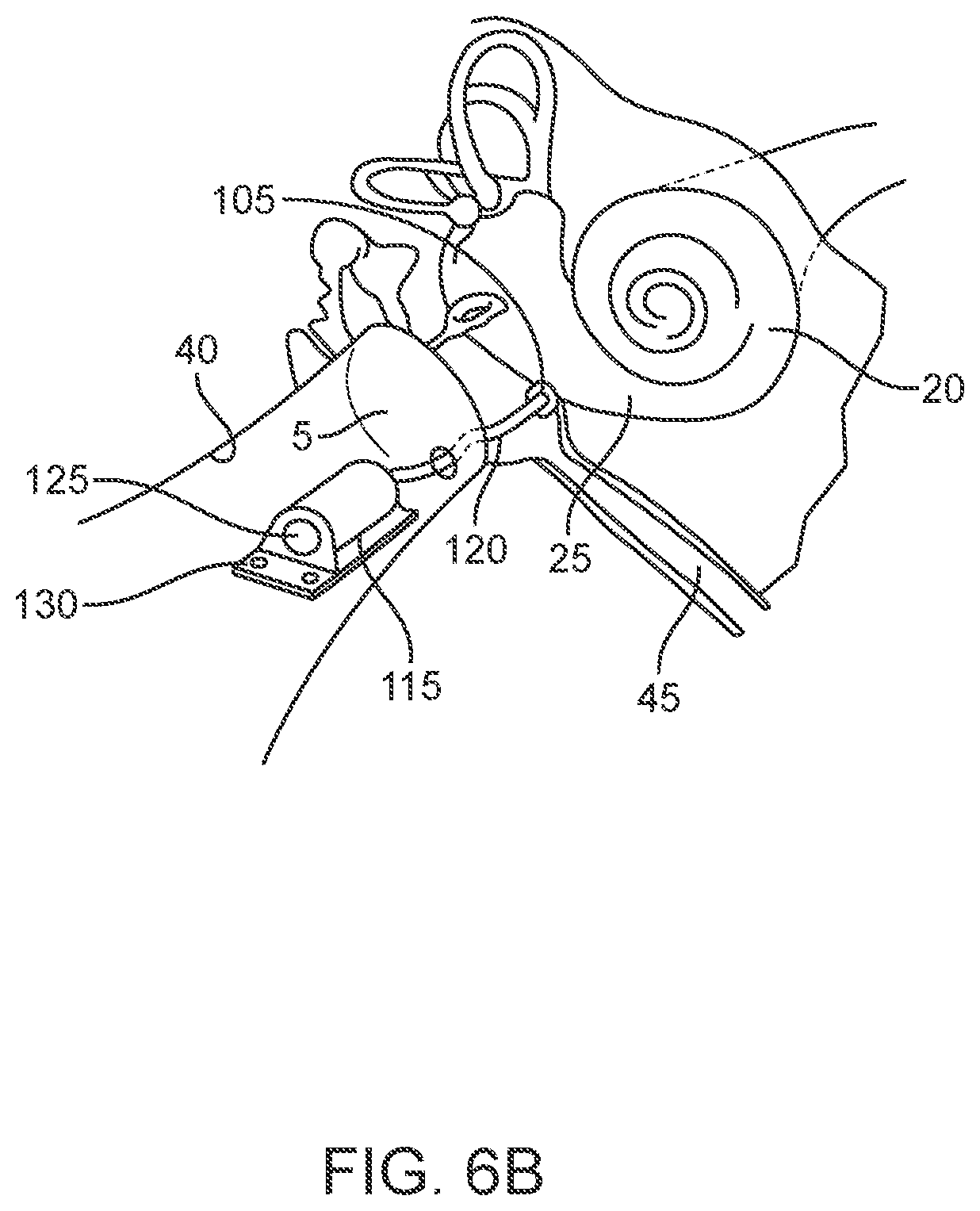 Patent US12102785 Figure 7 – Inner ear drug delivery devices and methods of use