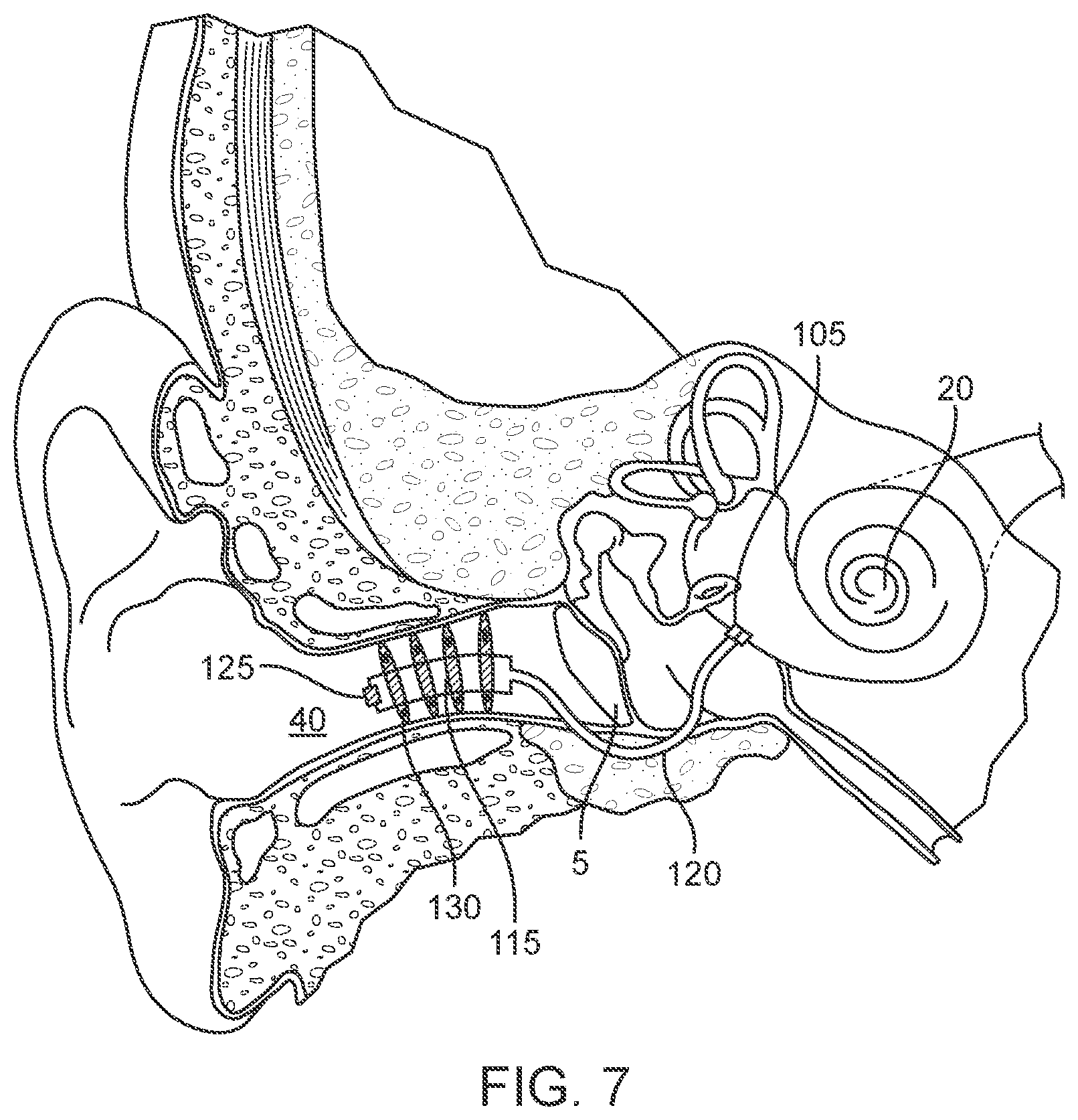 Patent US12102785 Figure 8 – Inner ear drug delivery devices and methods of use