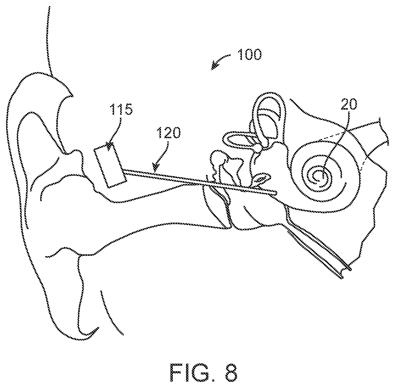 Patent US12102785 Figure 9 – Inner ear drug delivery devices and methods of use