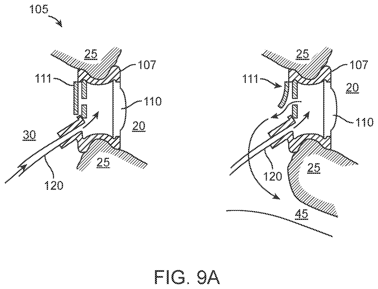 Patent US12102785 Figure 10 – Inner ear drug delivery devices and methods of use