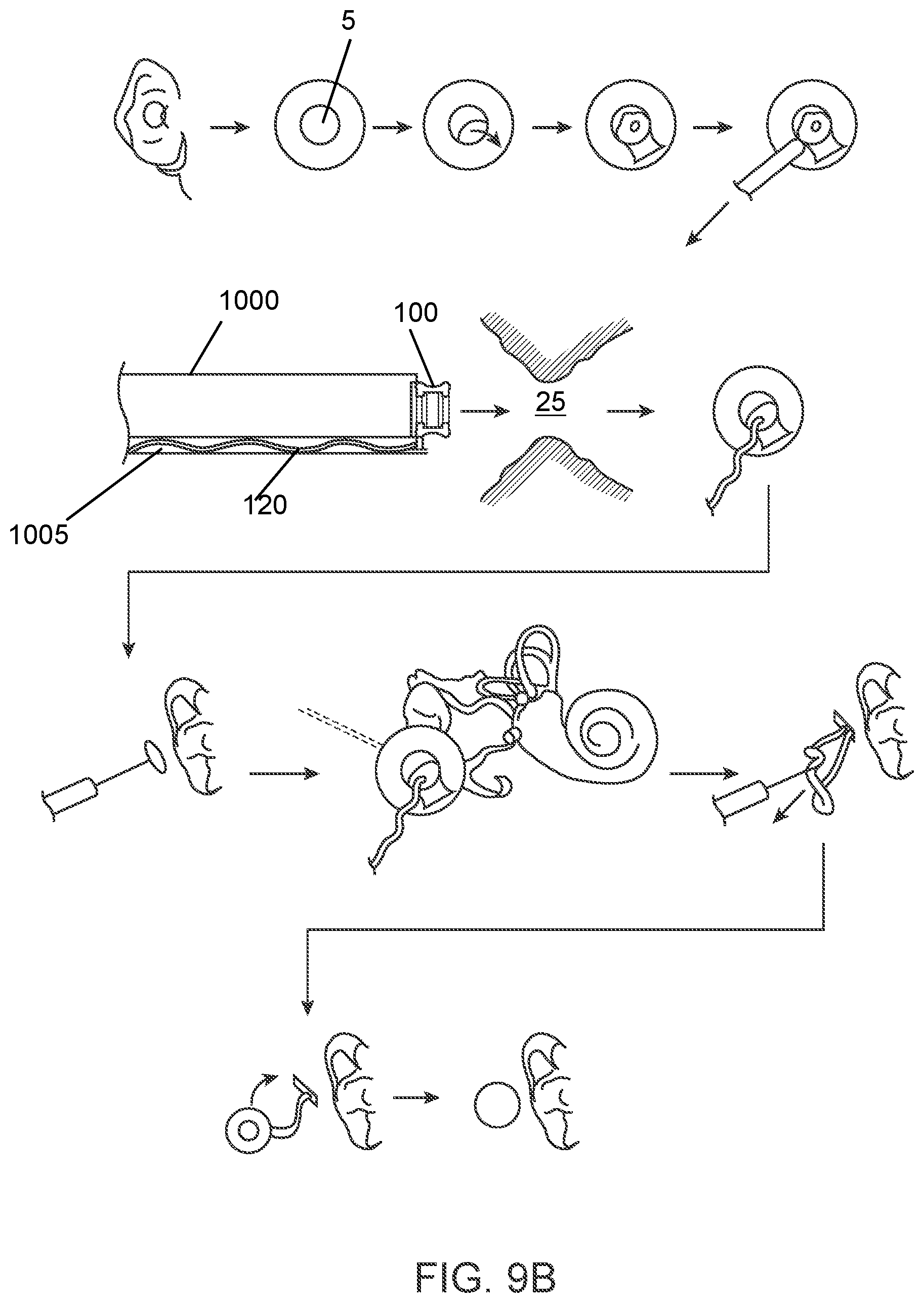 Patent US12102785 Figure 11 – Inner ear drug delivery devices and methods of use