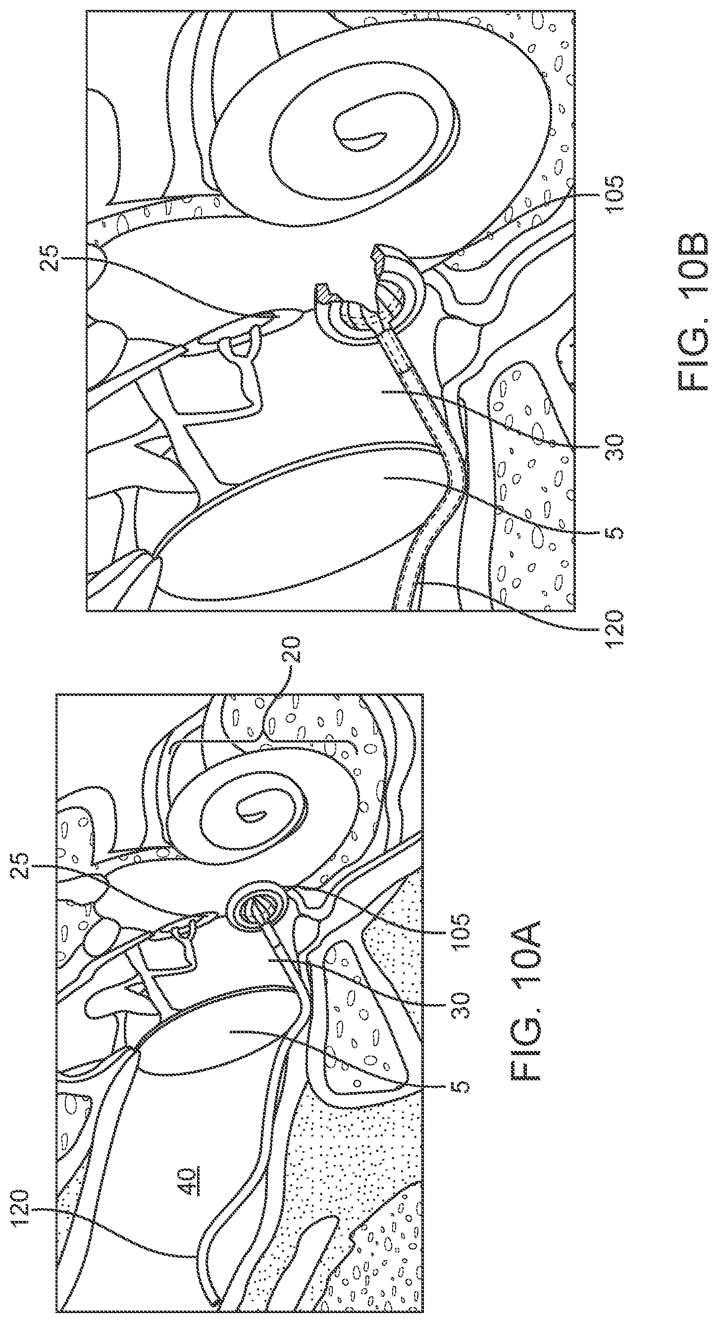 Patent US12102785 Figure 12 – Inner ear drug delivery devices and methods of use