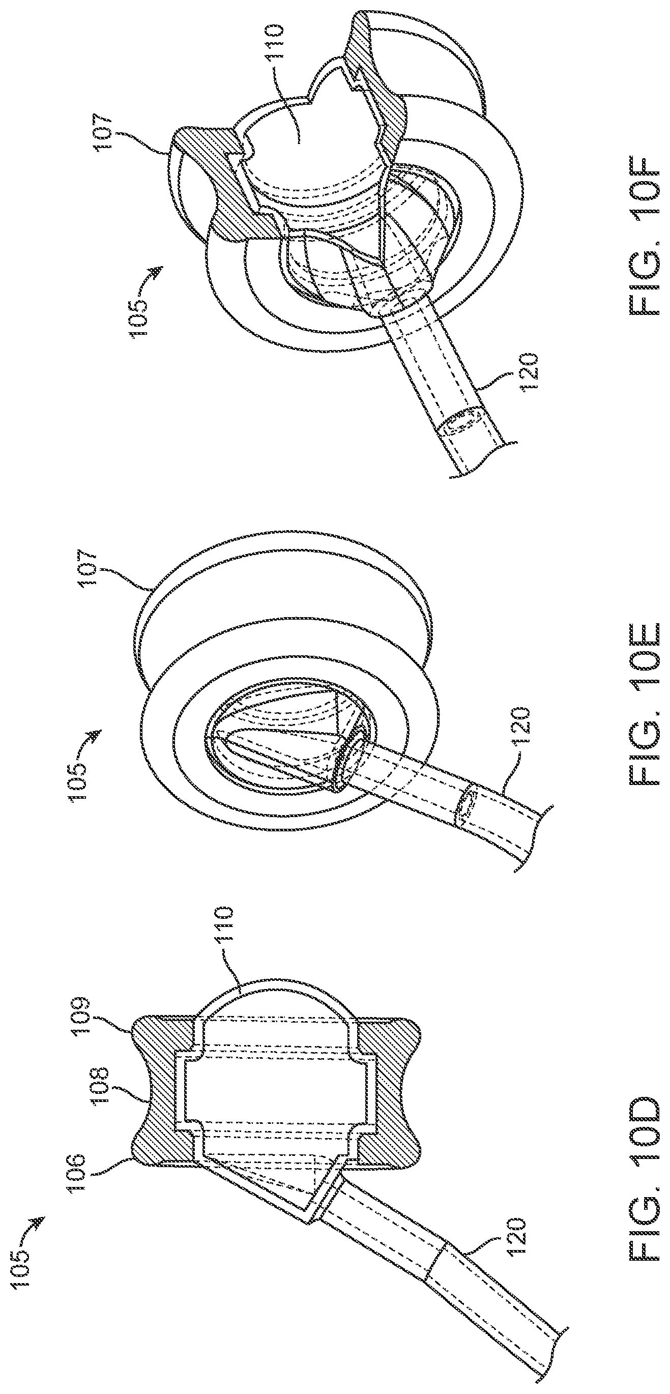 Patent US12102785 Figure 14 – Inner ear drug delivery devices and methods of use