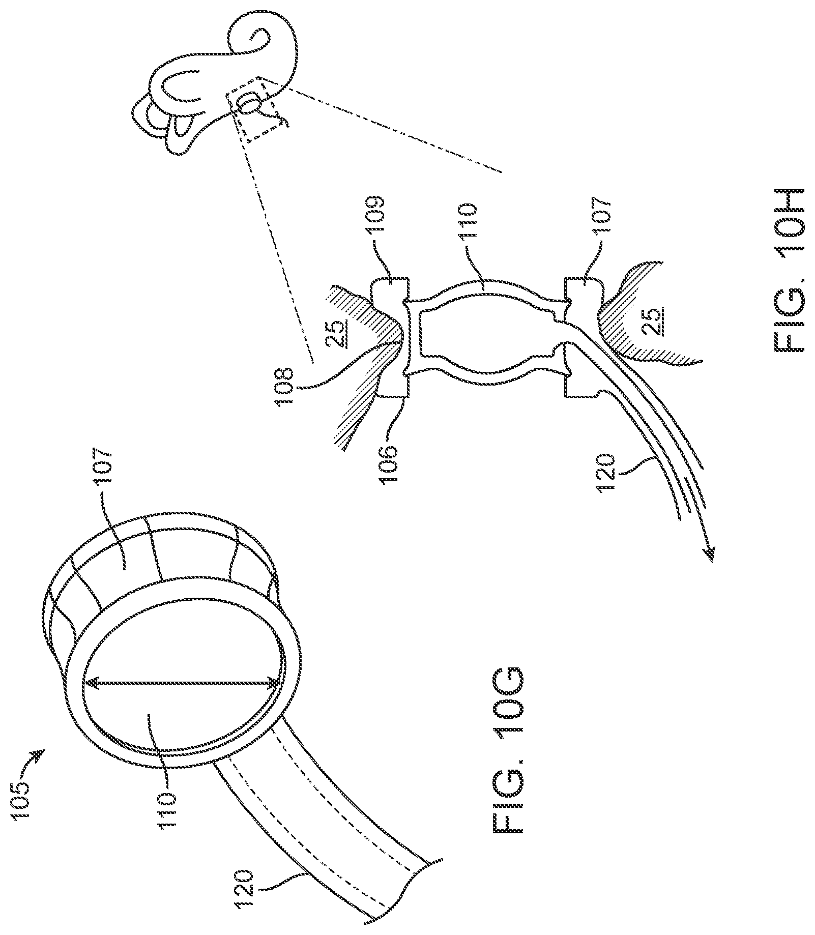 Patent US12102785 Figure 15 – Inner ear drug delivery devices and methods of use